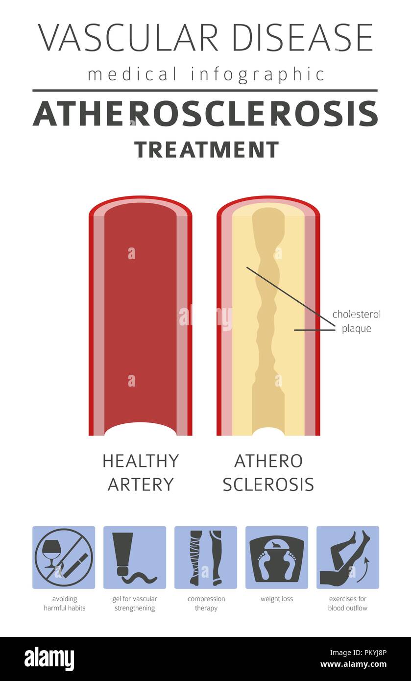 Vascular diseases. Atherosclerosis symptoms, treatment icon set. Medical infographic design. Vector illustration Stock Vector