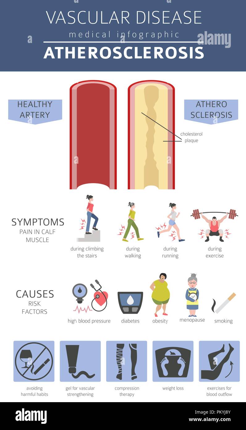 Vascular diseases. Atherosclerosis symptoms, treatment icon set. Medical infographic design. Vector illustration Stock Vector