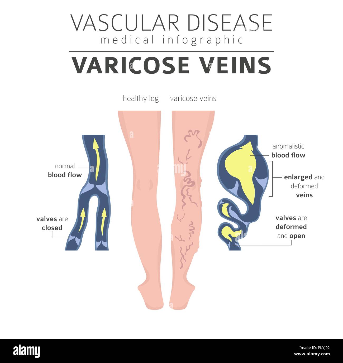 Vascular diseases. Varicose veins symptoms, treatment icon set. Medical infographic design. Vector illustration Stock Vector