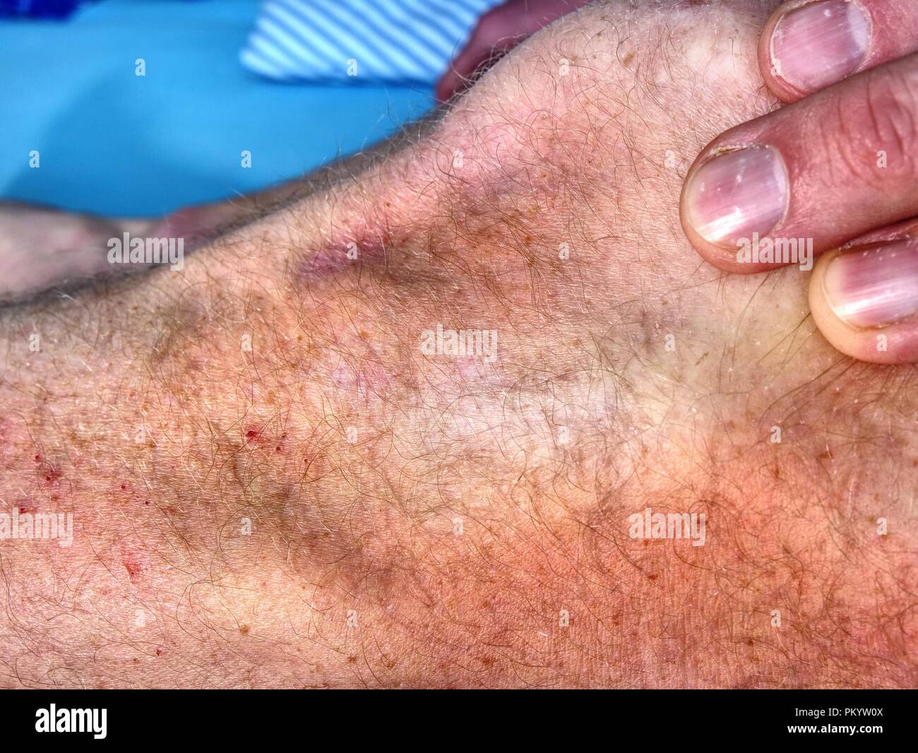 Hand embracing injured leg with painful hematoma and scratches from fall. Detail of affected skin. Stock Photo