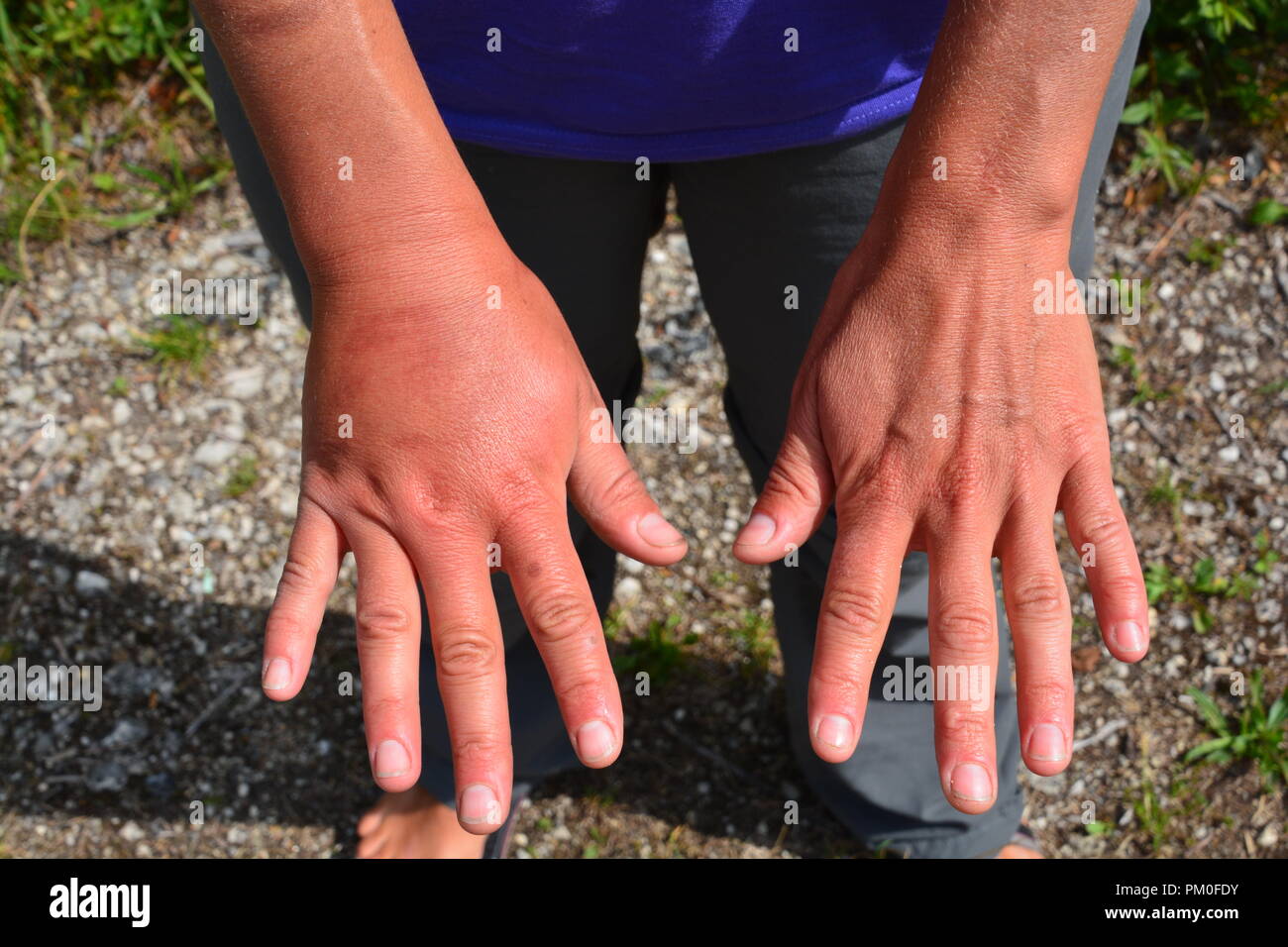 Red Wasp Sting Swelling