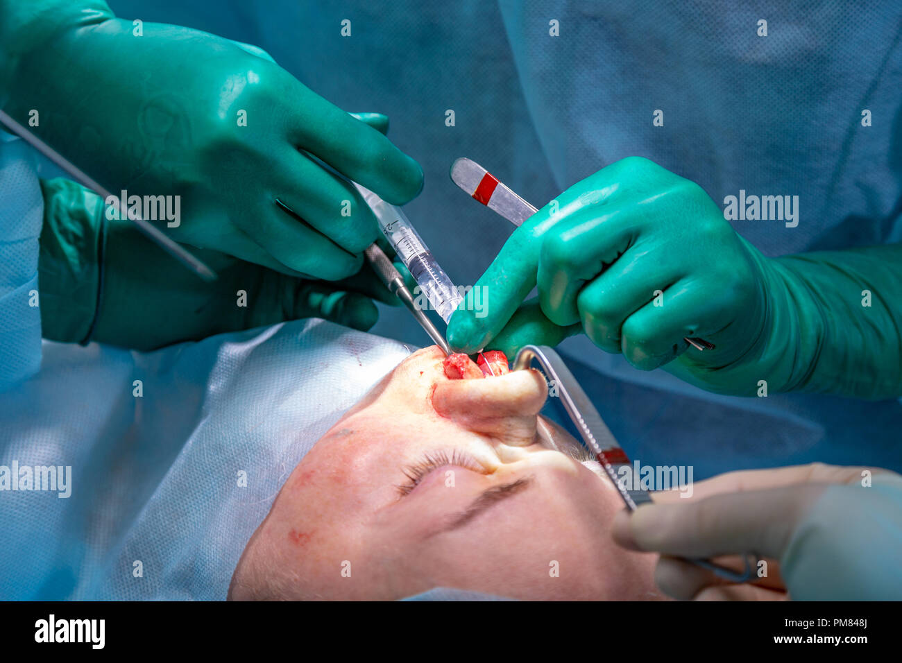 Rhinoplasty High Resolution Stock Photography and Images Alamy