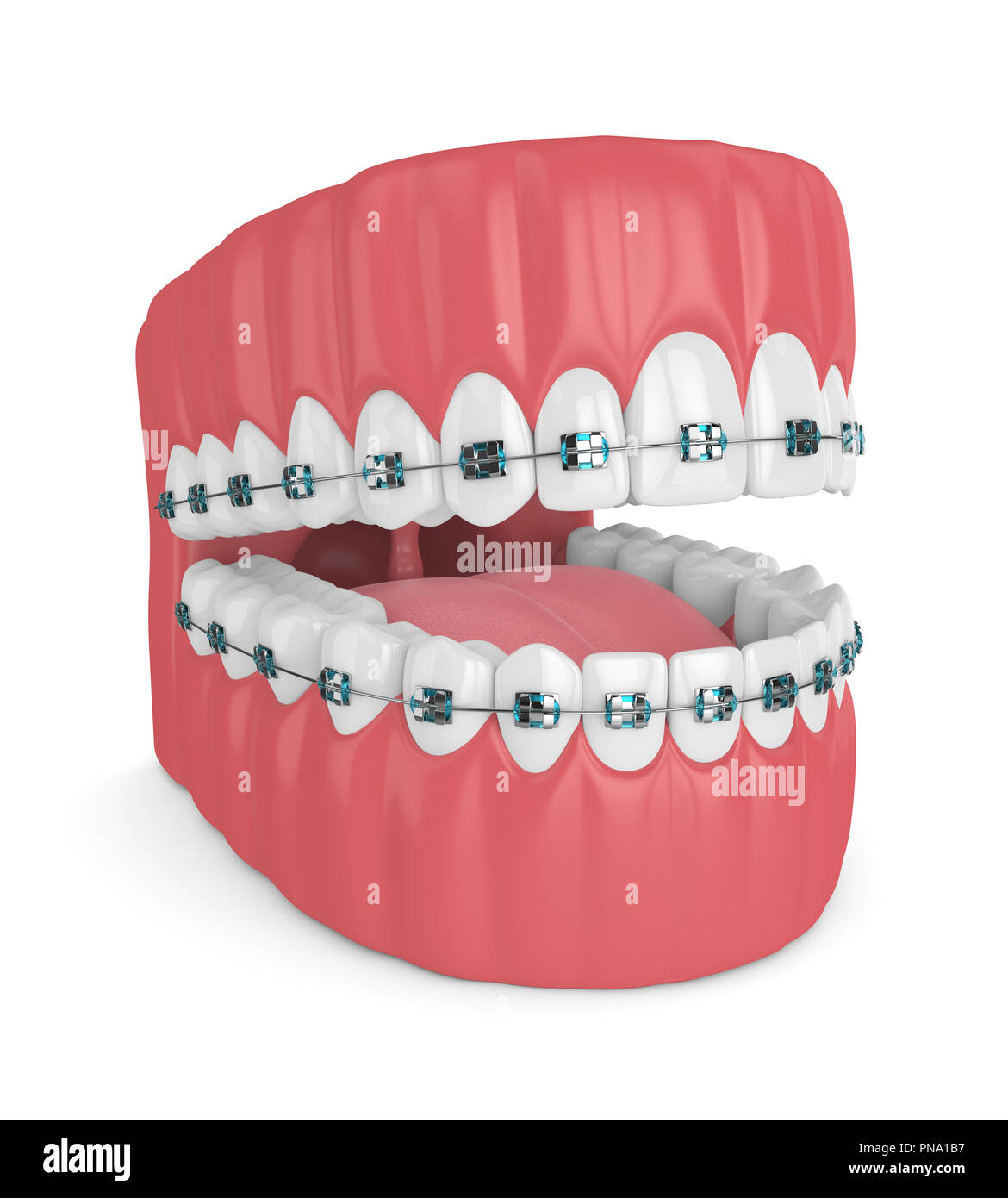 3d render of jaw with teeth and orthodontic braces isolated over white ...