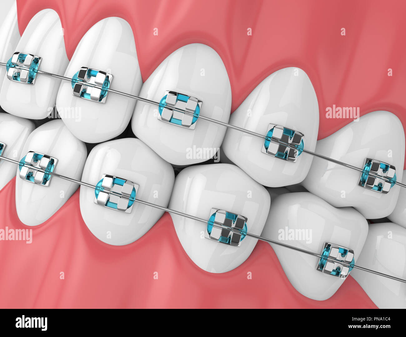3d render of jaw with teeth and orthodontic braces isolated over white ...