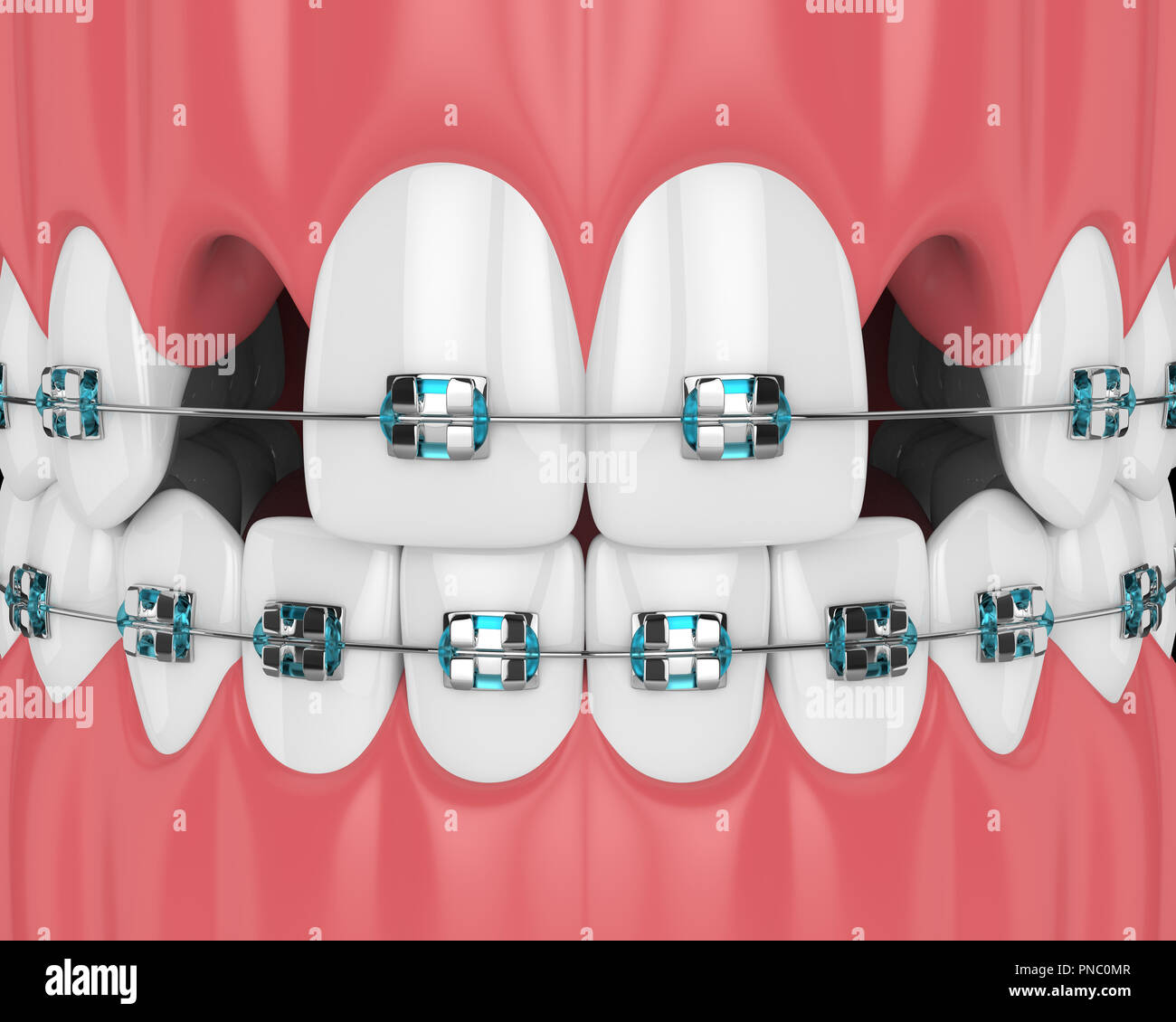 3d render of teeth with orthodontic braces and cavities. Orthodontic ...