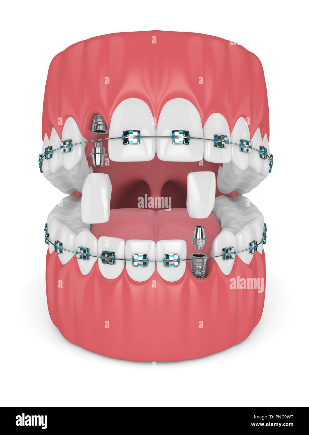 3d render of teeth with orthodontic braces and dental implants ...