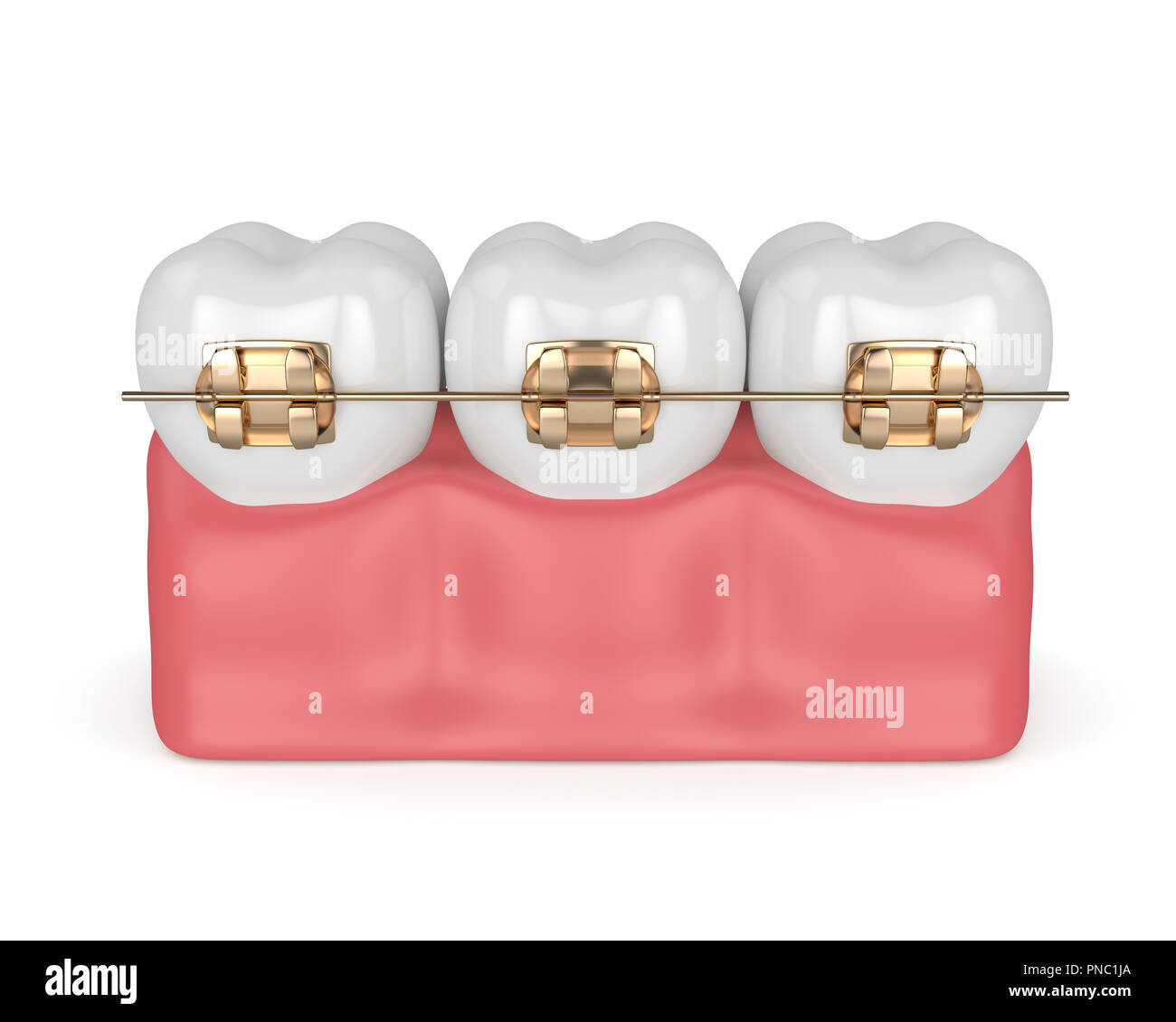3d render of teeth with golden orthodontic braces isolated over white ...