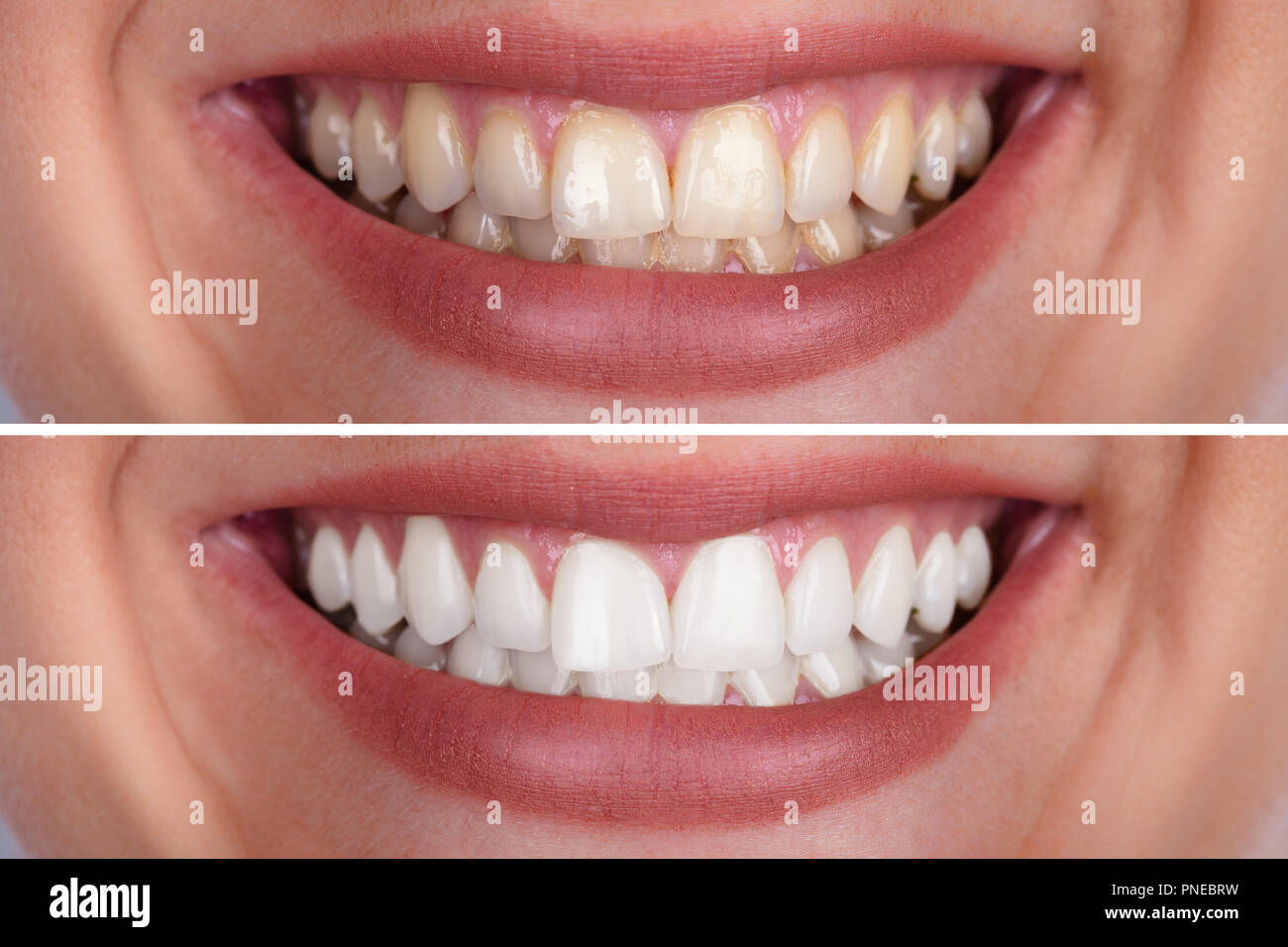 Close-up Of A Smiling Woman's Teeth Before And After Whitening Stock Photo