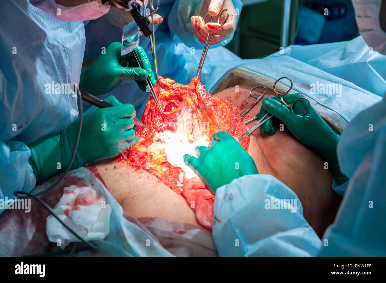 Surgical operation abdominoplasty. Close-up of the patient on the operating table, surgical removal of fat tissue from the abdomen. Stock Photo
