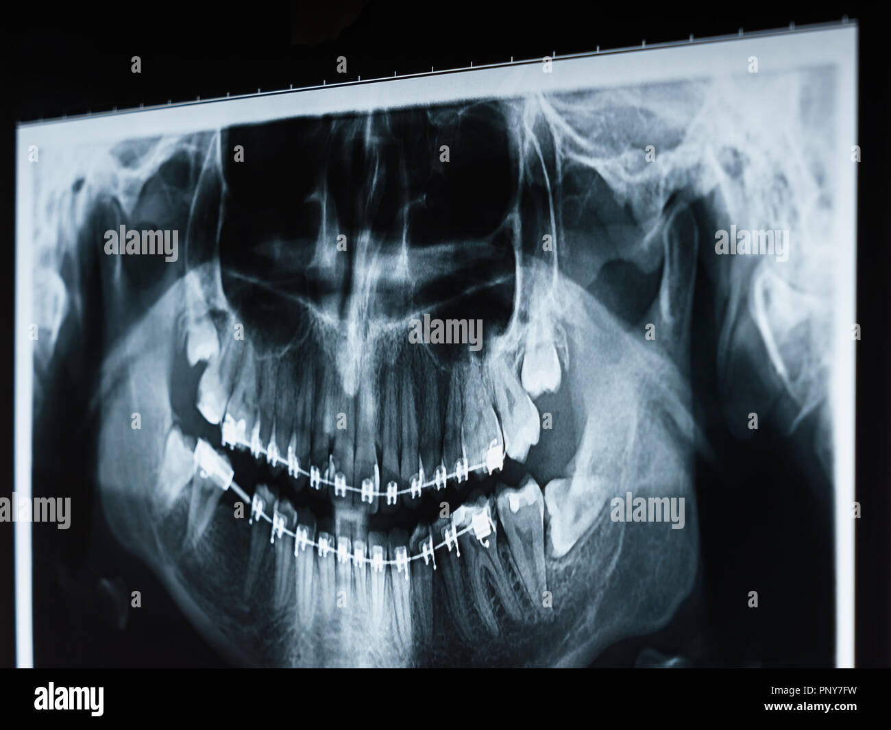 Dental X-Ray Photo Of Human Skull And Teeth With Braces Stock Photo
