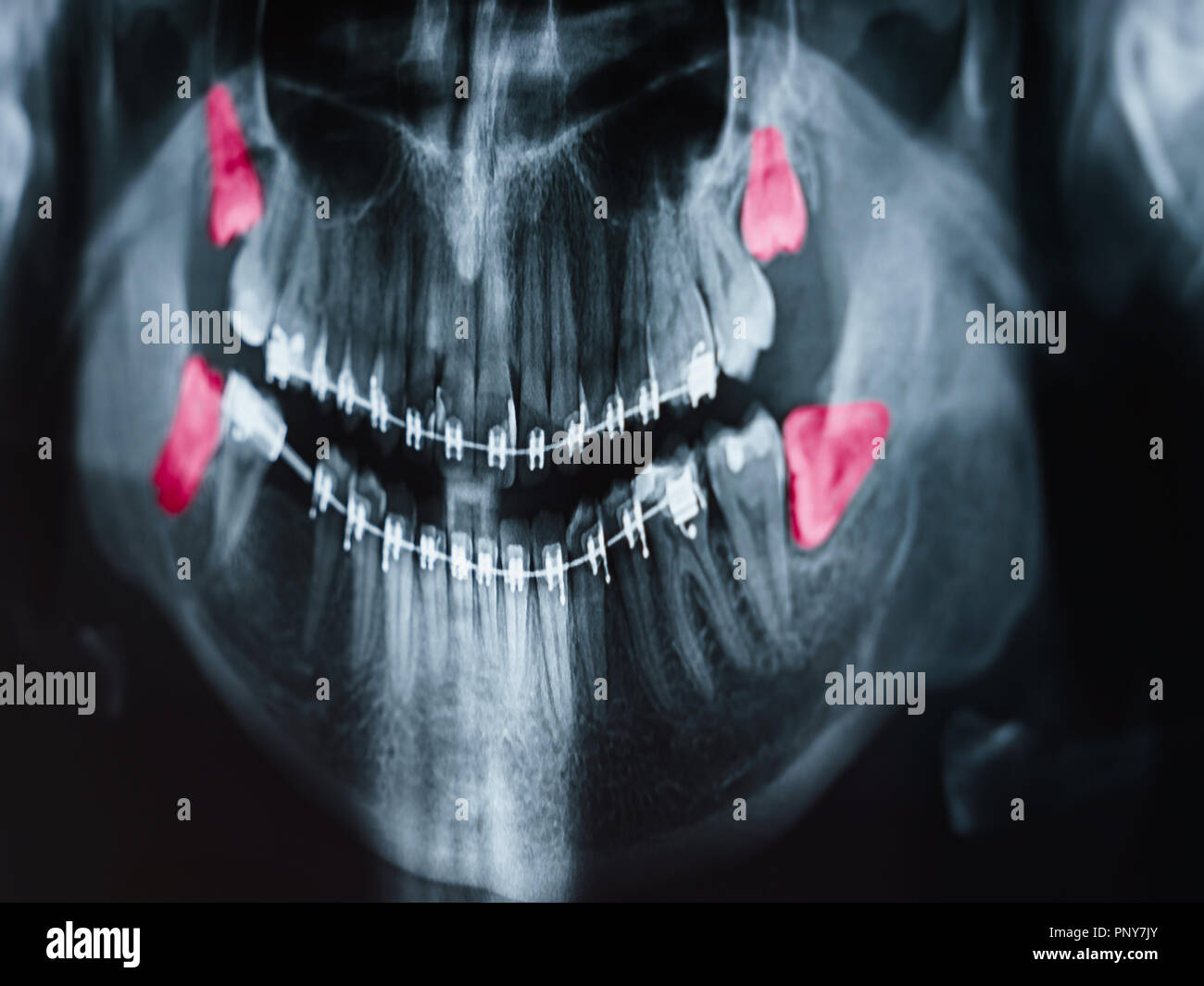 Growing Wisdom Teeth Pain On X-Ray Stock Photo