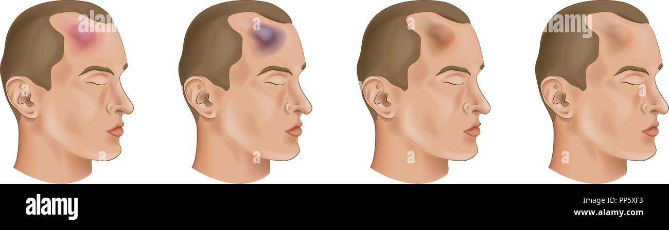 vector illustration of a bruise on a mans head Stock Vector