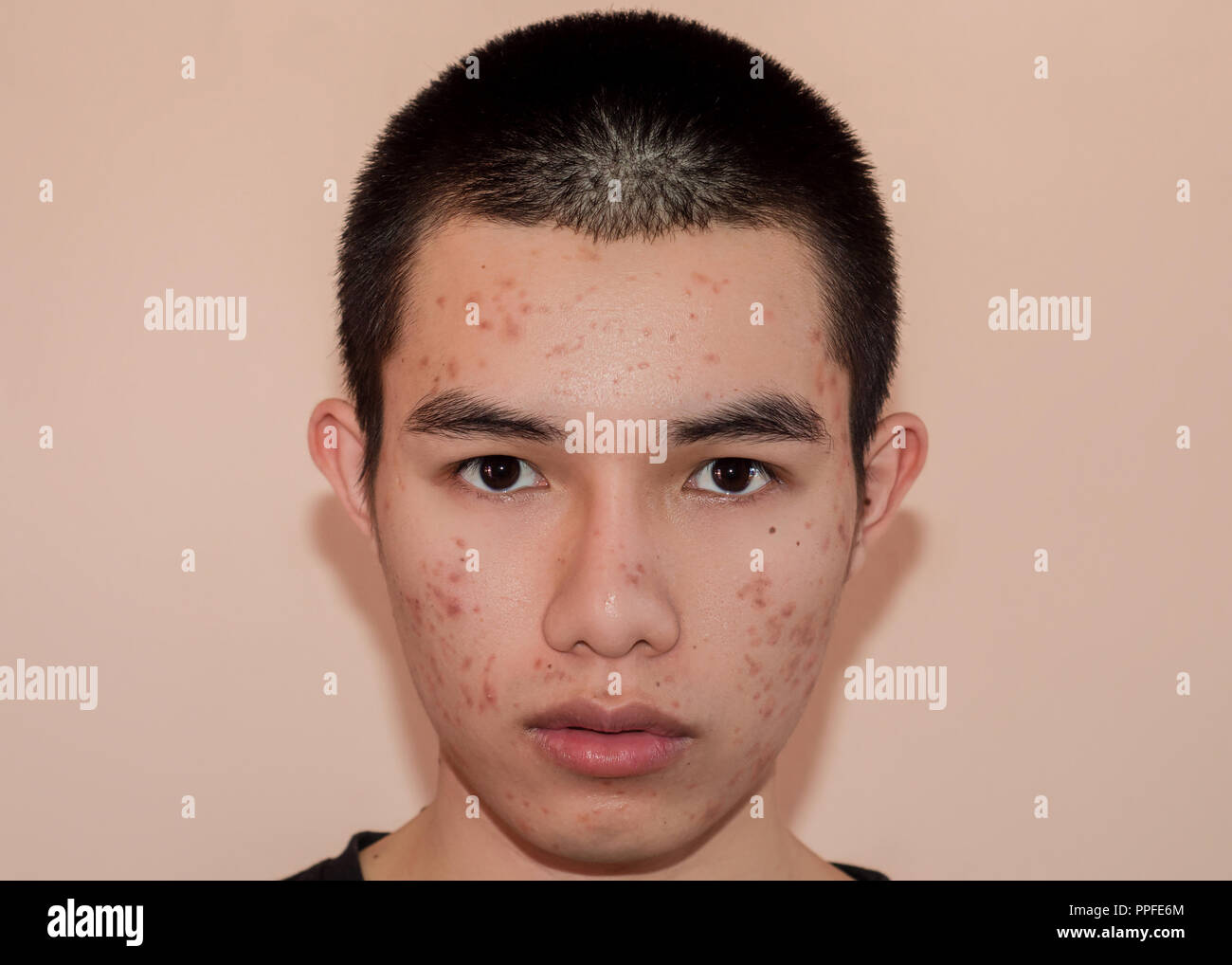 Young man with acne and pimple on the skin with brown spots, Acne on the face caused by Hormone or grime and bacteria, The scars and wrinkle and acne  Stock Photo