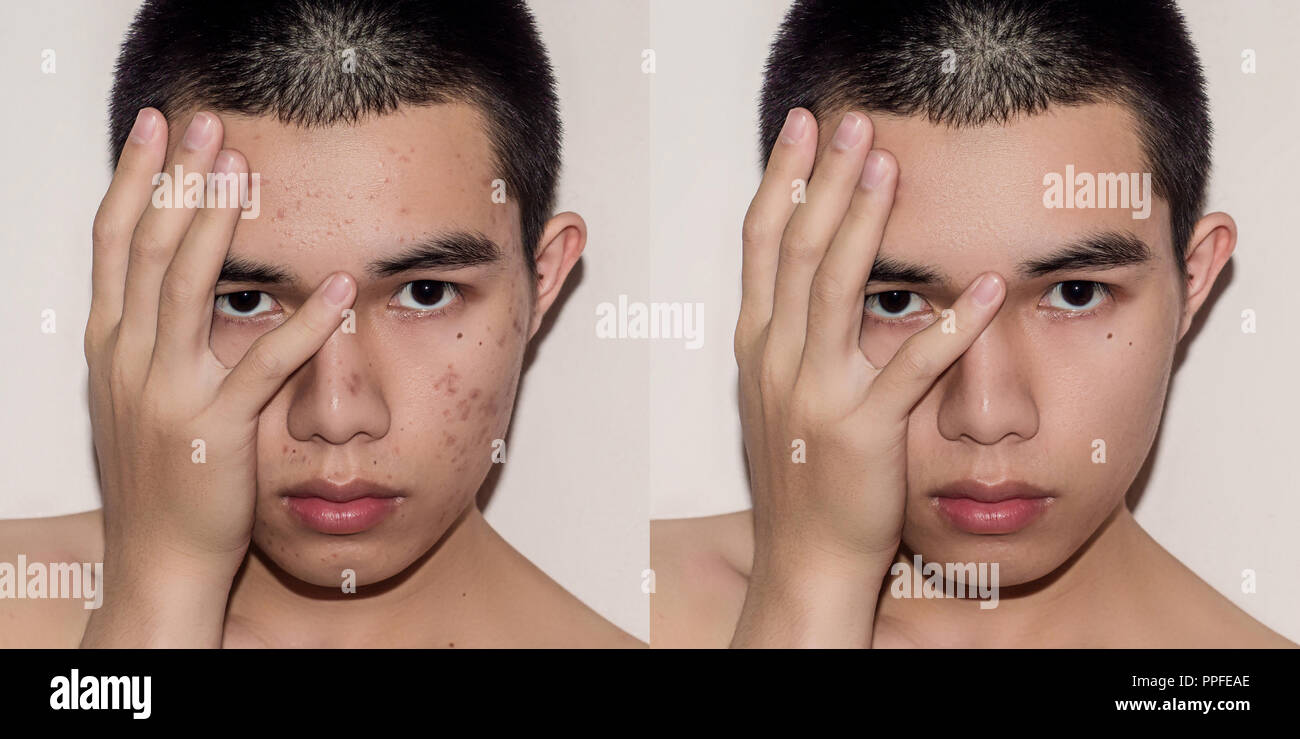 Young man with before and after treatment from acne and pimple, Before and after of face skin treat by scars and wrinkle by acne removal. Spots skin b Stock Photo