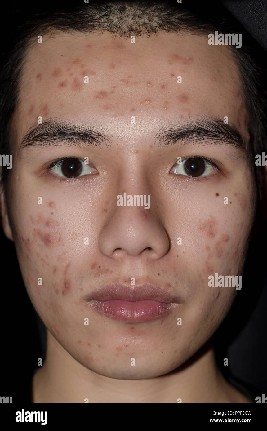 Young man with acne and pimple on the skin with brown spots, Acne on the face caused by Hormone or grime and bacteria, The scars and wrinkle and acne  Stock Photo