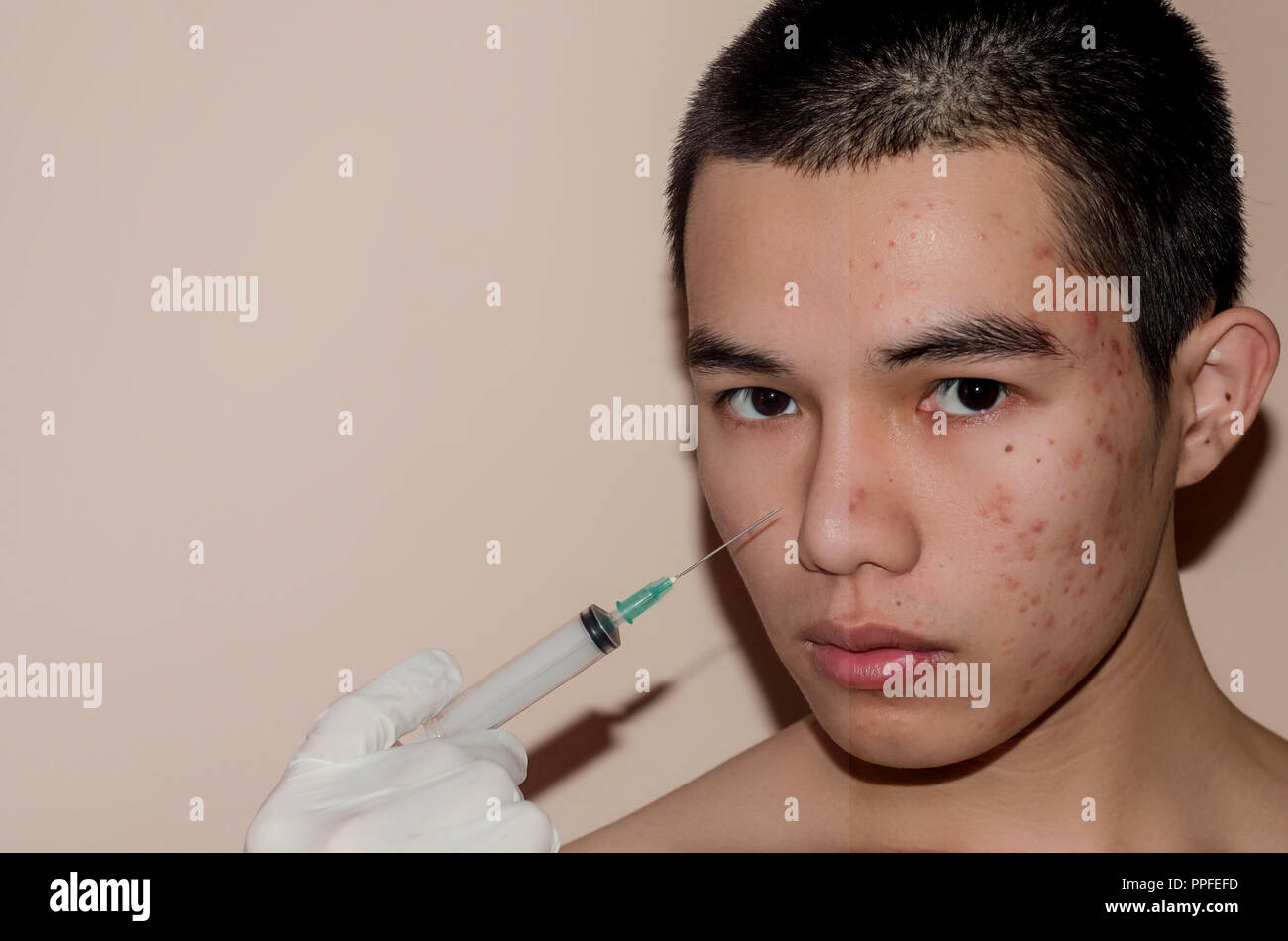 Young man with before and after treatment from acne and pimple, Before and after of face skin treat by scars and wrinkle by acne removal. Spots skin b Stock Photo