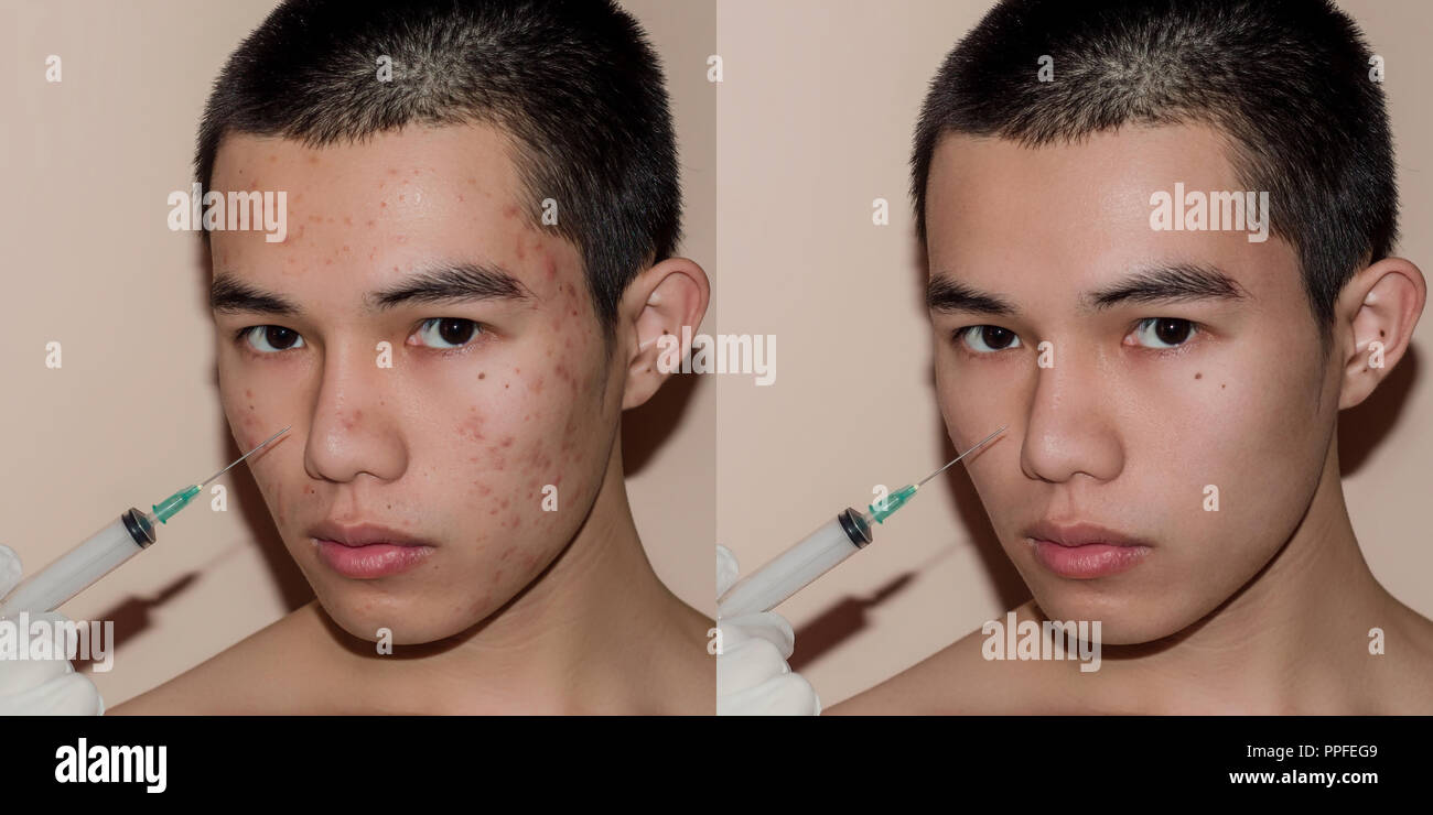 Young man with before and after treatment from acne and pimple, Before and after of face skin treat by scars and wrinkle by acne removal. Spots skin b Stock Photo