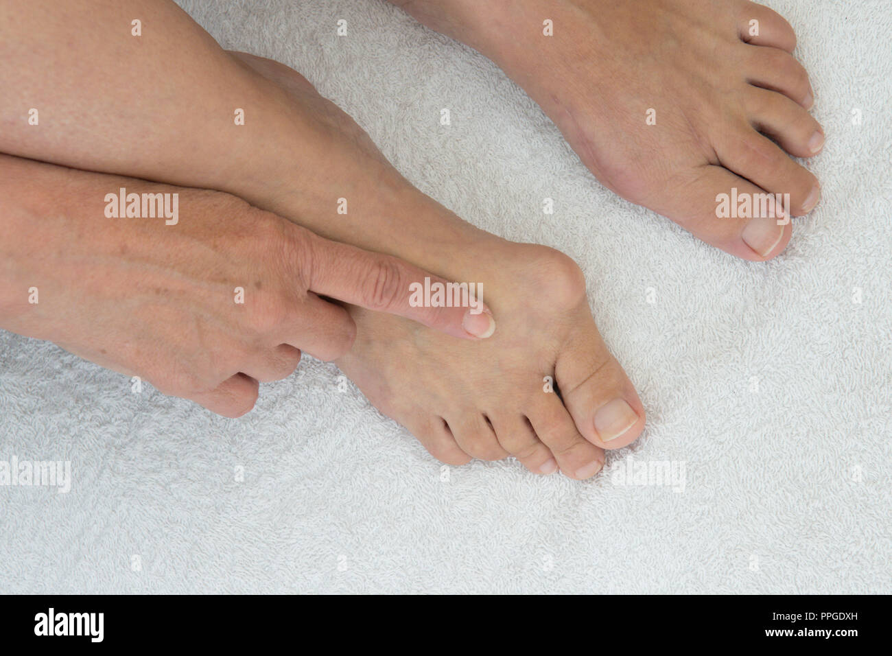 bunion on joint of big toe, before and after operation, comparison of one foot with bunion removed and other yet to be done, hand rubbing swelling. Stock Photo