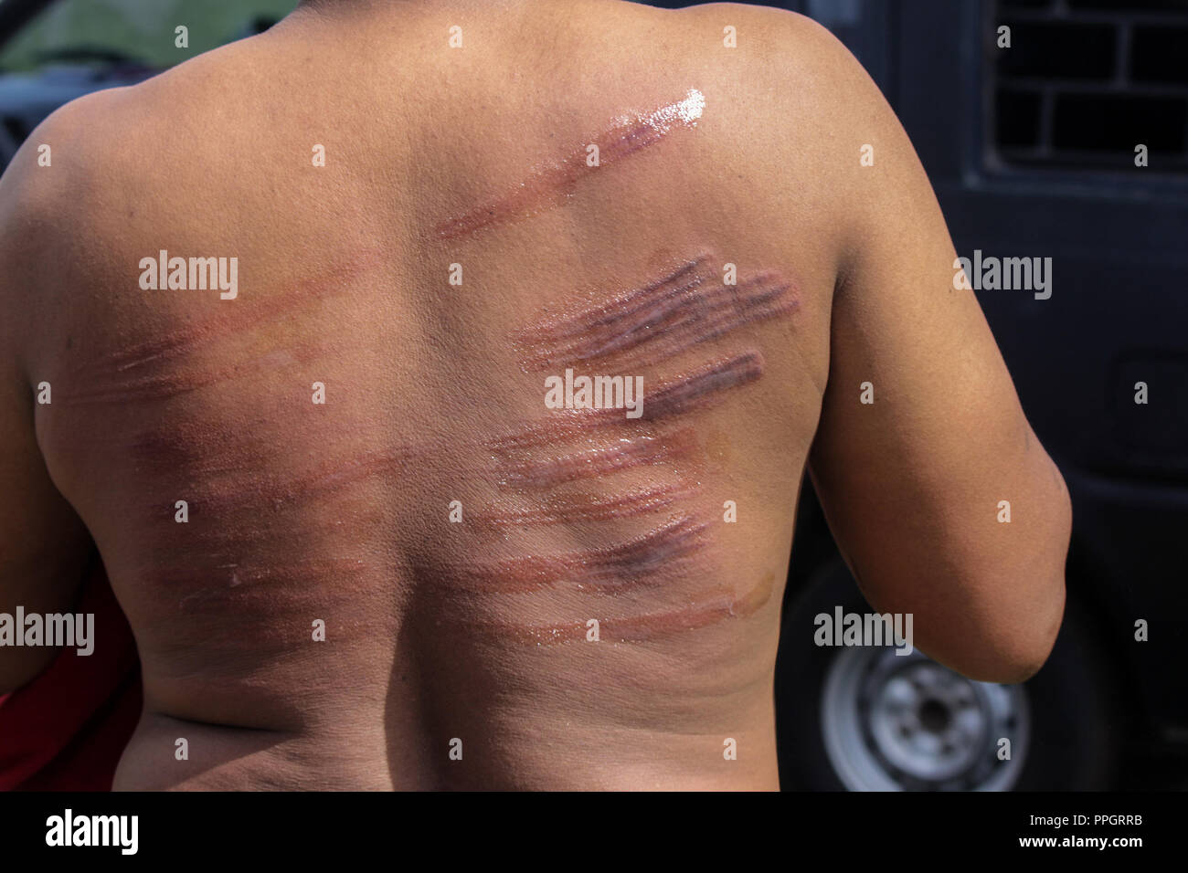 Lhokseumawe, Aceh, Indonesia. 25th Sep, 2018. A convicted person seen with wounds after being sentenced to whips for violating the Islamic Sharia law.Although considered to violate the International Convention against Cruel, Inhuman or Torture and Cruelty. Aceh, one of the provinces in Indonesia that insists on carrying out whipping as a province of Islamic Sharia law. Credit: Maskur Has/SOPA Images/ZUMA Wire/Alamy Live News Stock Photo