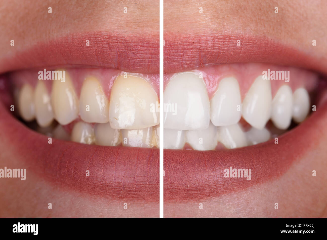 Close-up Of A Smiling Woman's Teeth Before And After Whitening Stock Photo