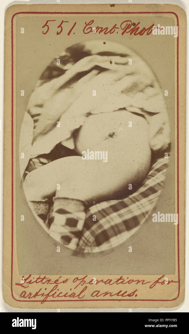 Littre's operation for artificial anus; J.H. Pooley, American, active 1870s - 1880s, December 22, 1871; Albumen silver print Stock Photo