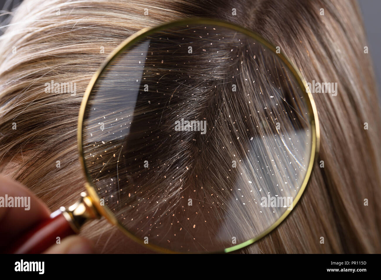 Itchy Scalp Stock Photos Itchy Scalp Stock Images Alamy
