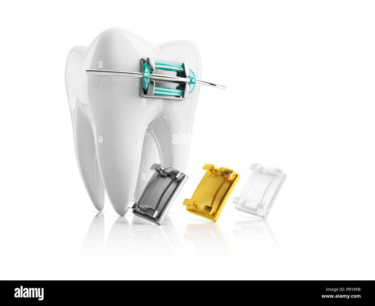 Tooth with bracket, illustration Stock Photo - Alamy