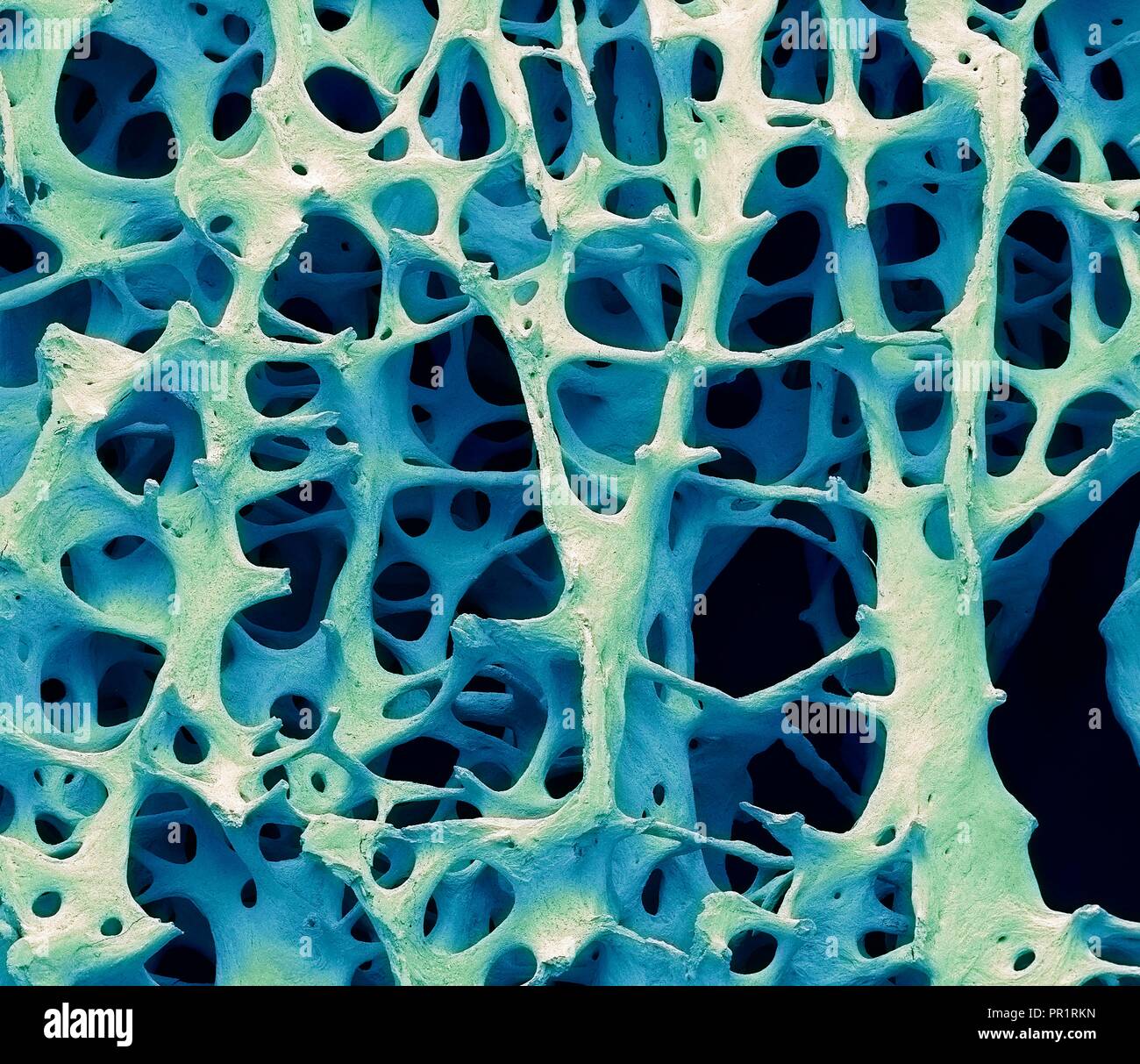 Bone tissue. Coloured scanning electron micrograph (SEM) of human cancellous (spongy) bone. Bone tissue can be either cortical (compact) or cancellous. Cortical bone usually makes up the exterior of the bone, while cancellous bone is found in the interior. Cancellous bone is characterised by a honeycomb arrangement, comprising a network of trabeculae (rod-shaped tissue). These structures provide support and strength to the bone. The spaces within this tissue contain bone marrow (not seen), a blood forming substance. Magnification: x13 when printed 10cm wide. Stock Photo