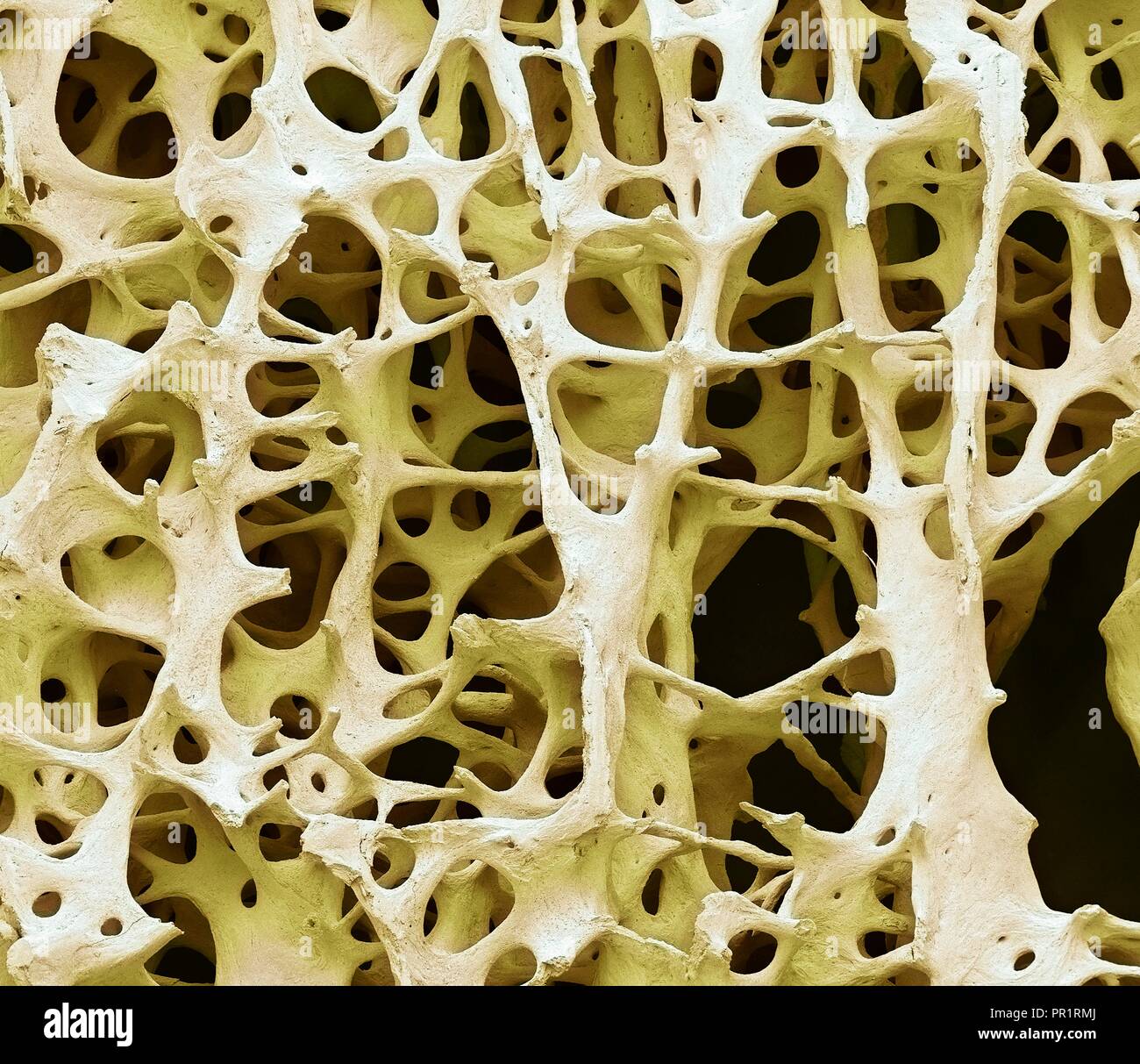 Bone tissue. Coloured scanning electron micrograph (SEM) of human cancellous (spongy) bone. Bone tissue can be either cortical (compact) or cancellous. Cortical bone usually makes up the exterior of the bone, while cancellous bone is found in the interior. Cancellous bone is characterised by a honeycomb arrangement, comprising a network of trabeculae (rod-shaped tissue). These structures provide support and strength to the bone. The spaces within this tissue contain bone marrow (not seen), a blood forming substance. Magnification: x13 when printed 10cm wide. Stock Photo