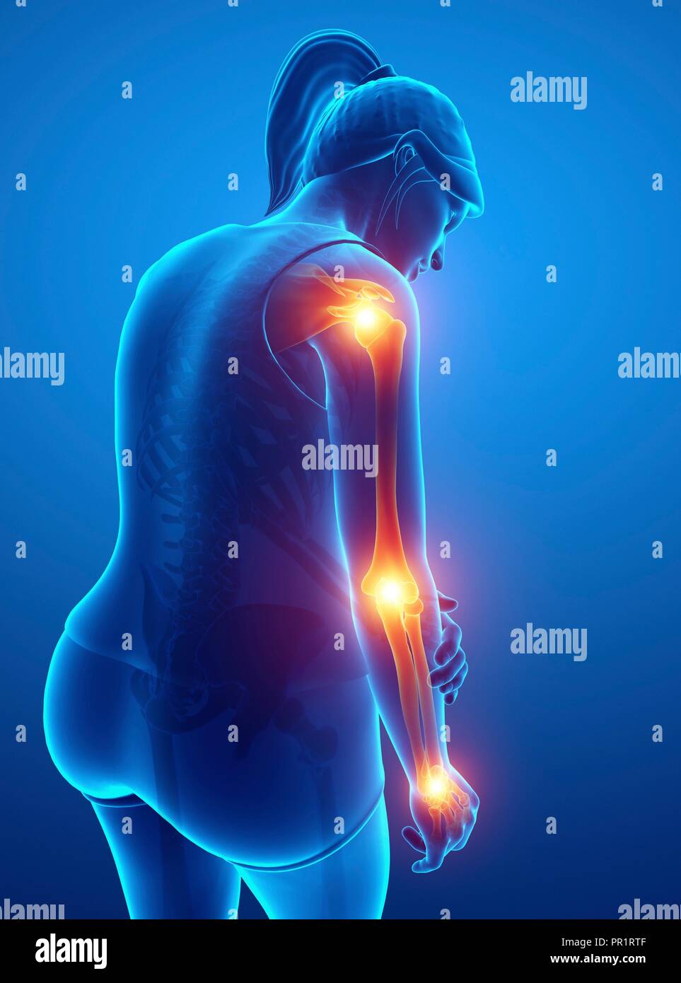 Woman with arm pain, computer illustration Stock Photo Alamy