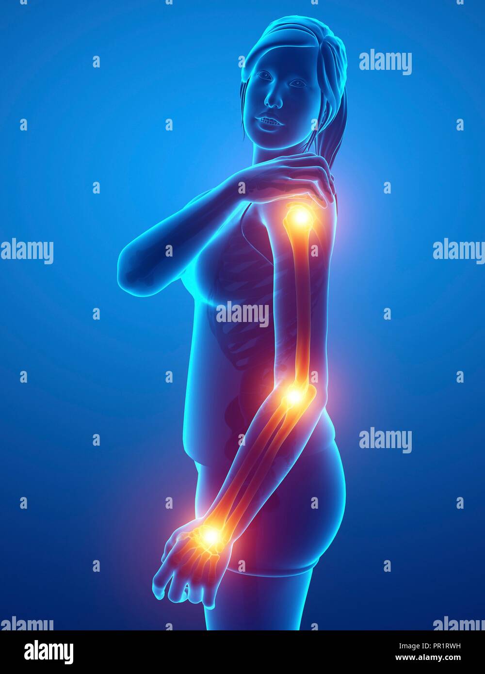 Woman with arm pain, computer illustration Stock Photo Alamy