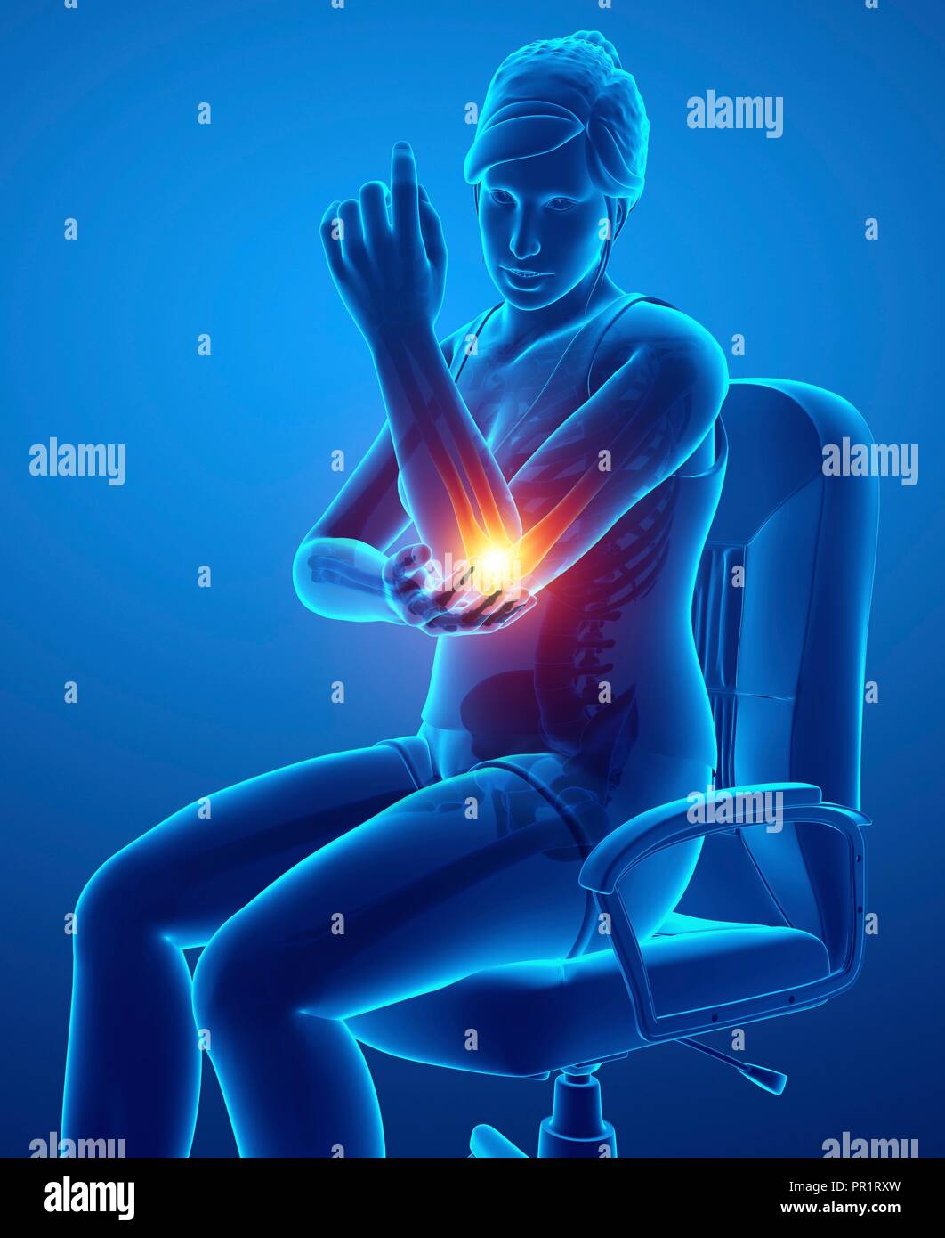 Woman with elbow pain, computer illustration Stock Photo Alamy