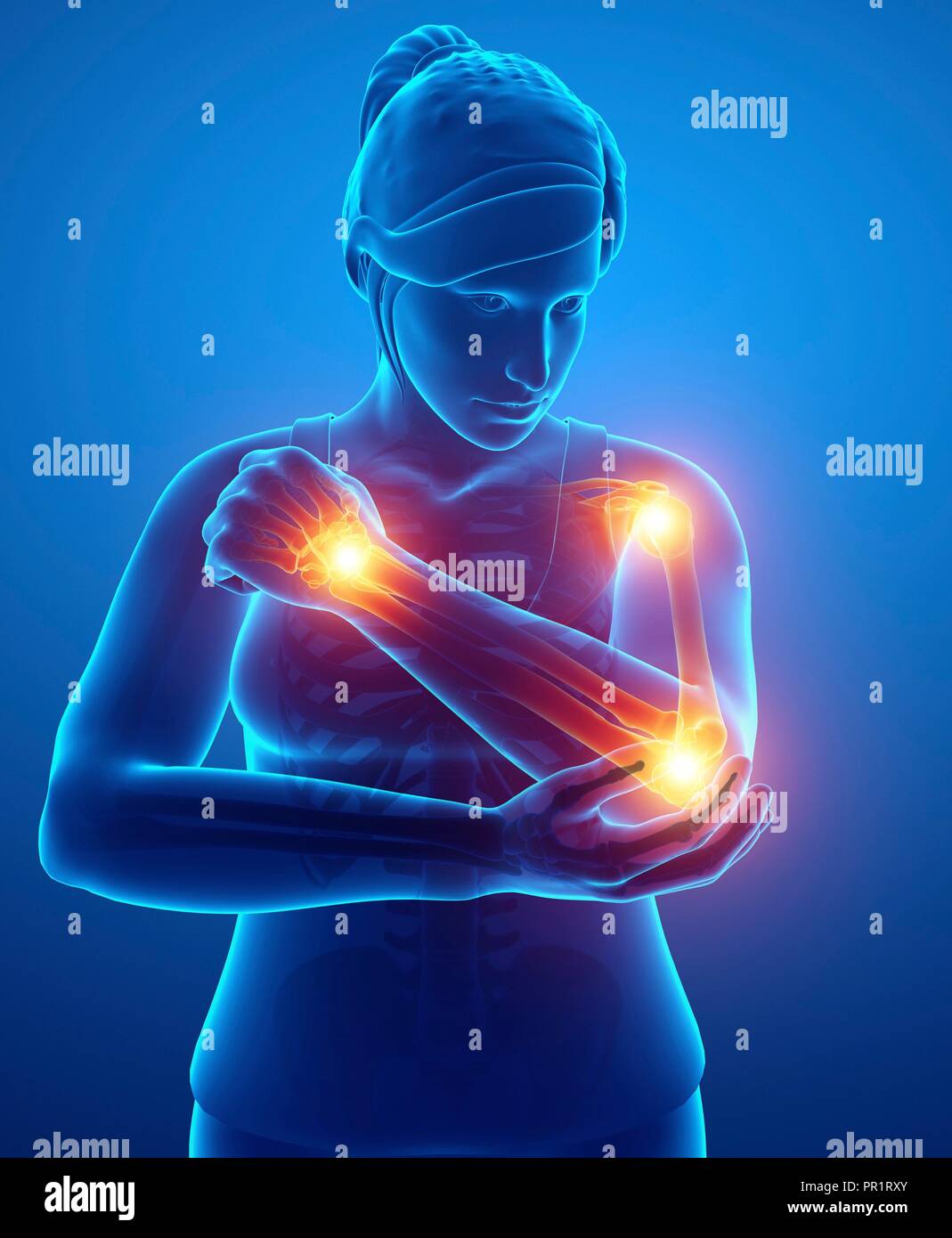 Woman with arm pain, computer illustration Stock Photo Alamy