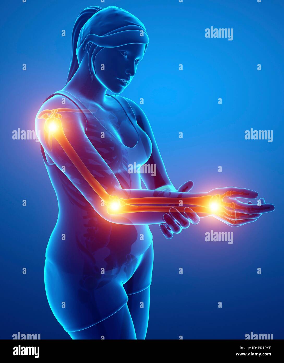 Woman with arm pain, computer illustration Stock Photo Alamy