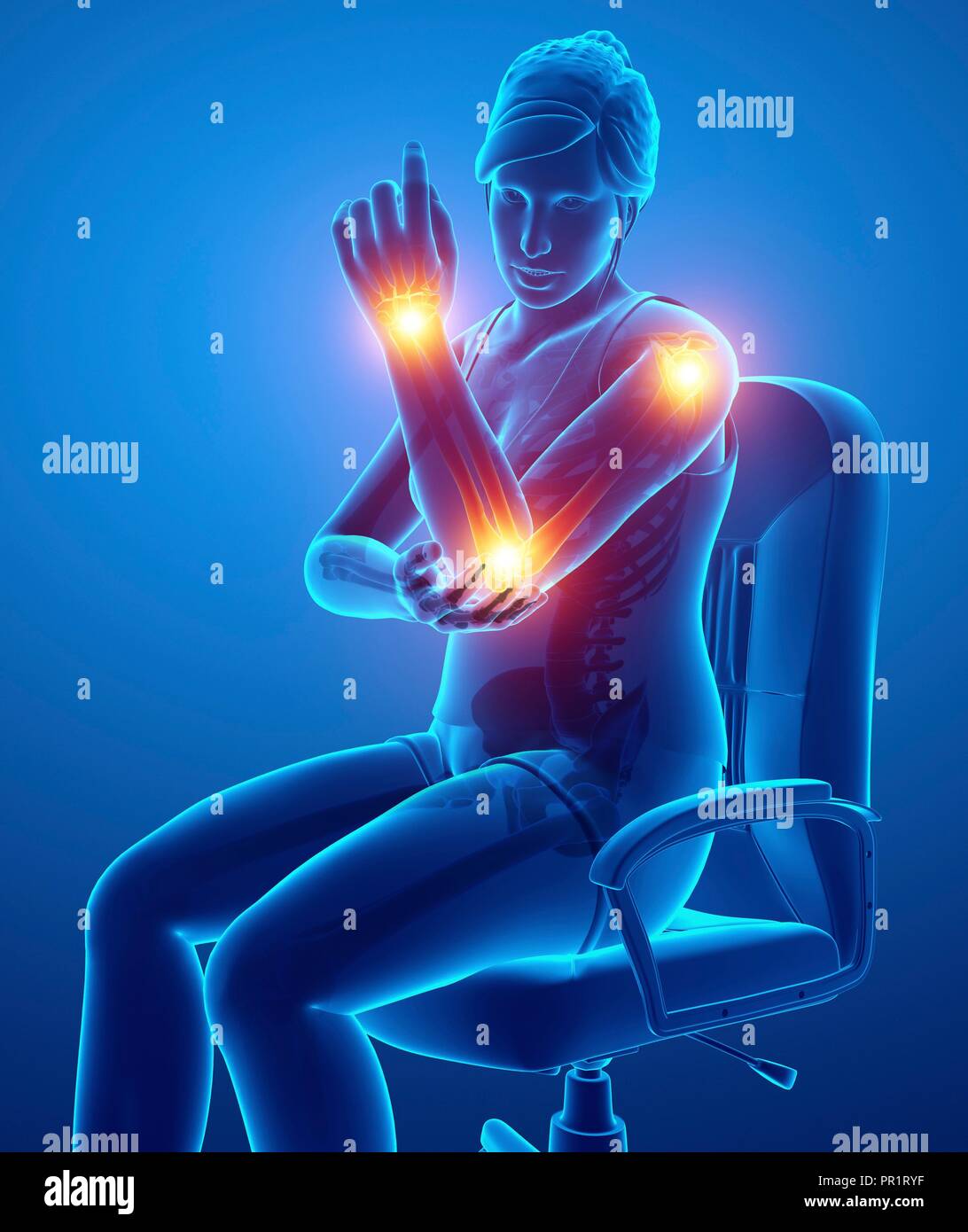 Woman with arm pain, computer illustration Stock Photo Alamy
