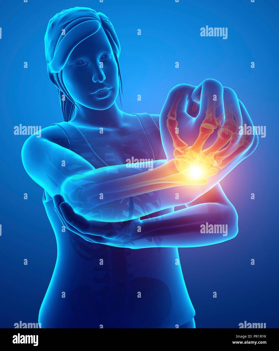 Woman with elbow pain, computer illustration Stock Photo Alamy