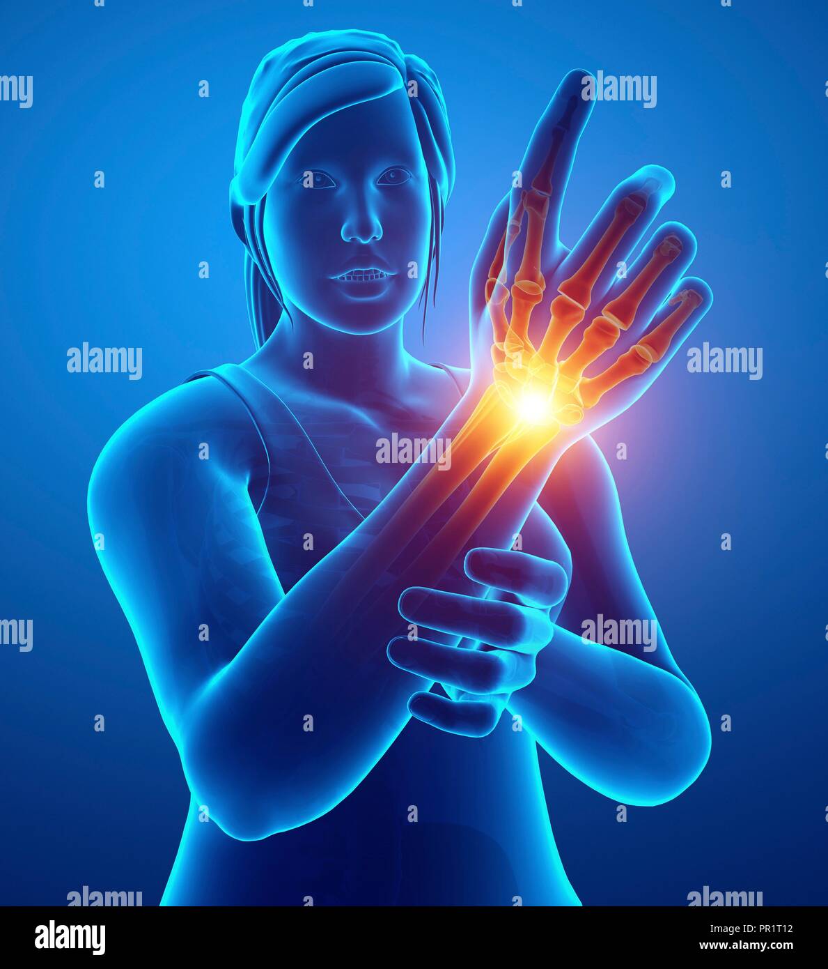 Woman with wrist pain, computer illustration Stock Photo Alamy