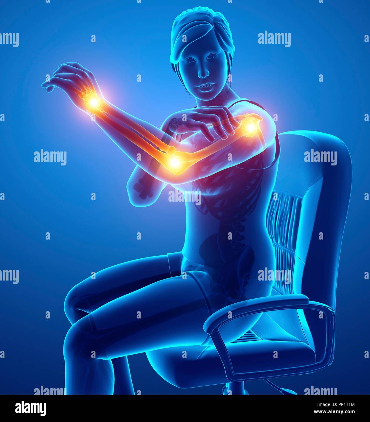 Woman with arm pain, computer illustration Stock Photo Alamy