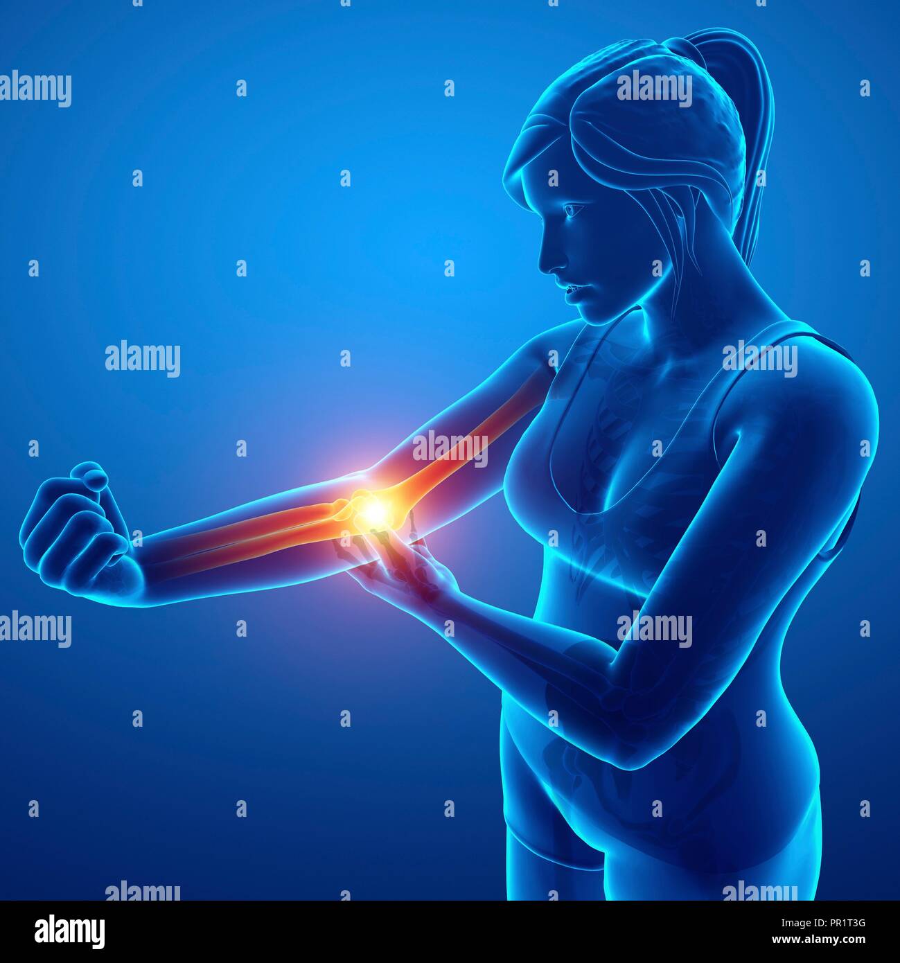Woman with elbow pain, computer illustration Stock Photo Alamy
