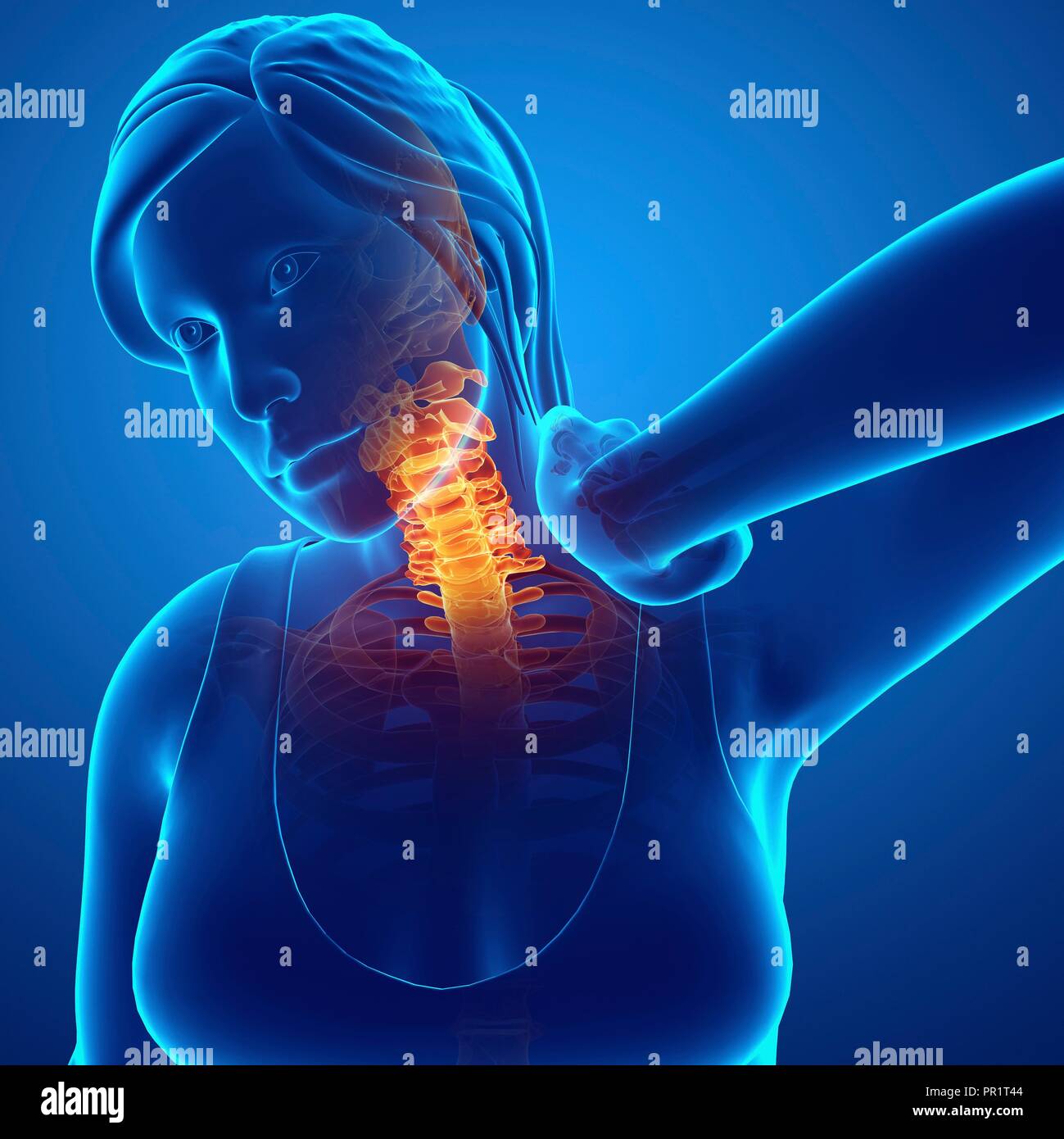 Woman with neck pain, computer illustration Stock Photo Alamy