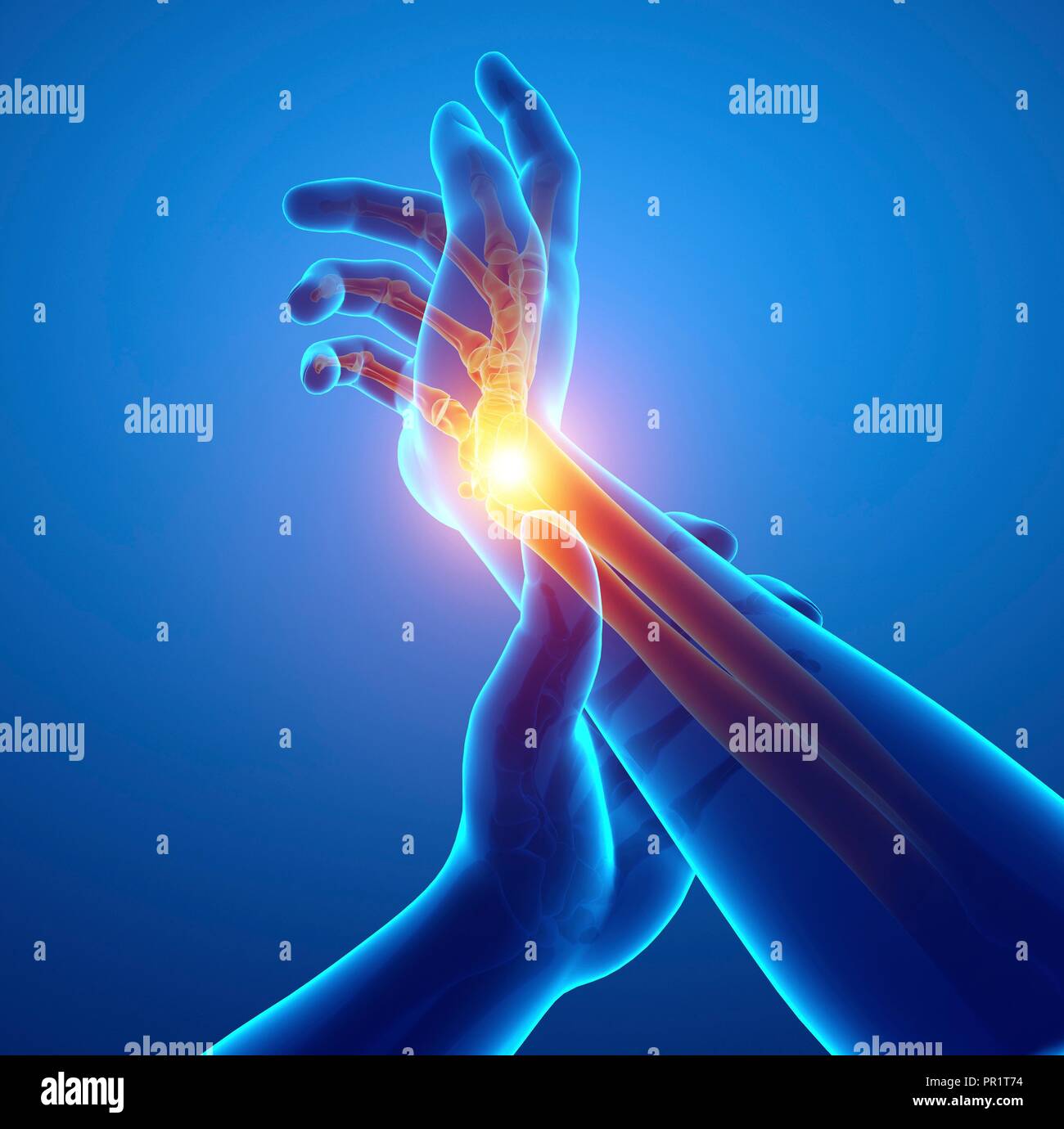 Man with wrist pain, computer illustration Stock Photo Alamy