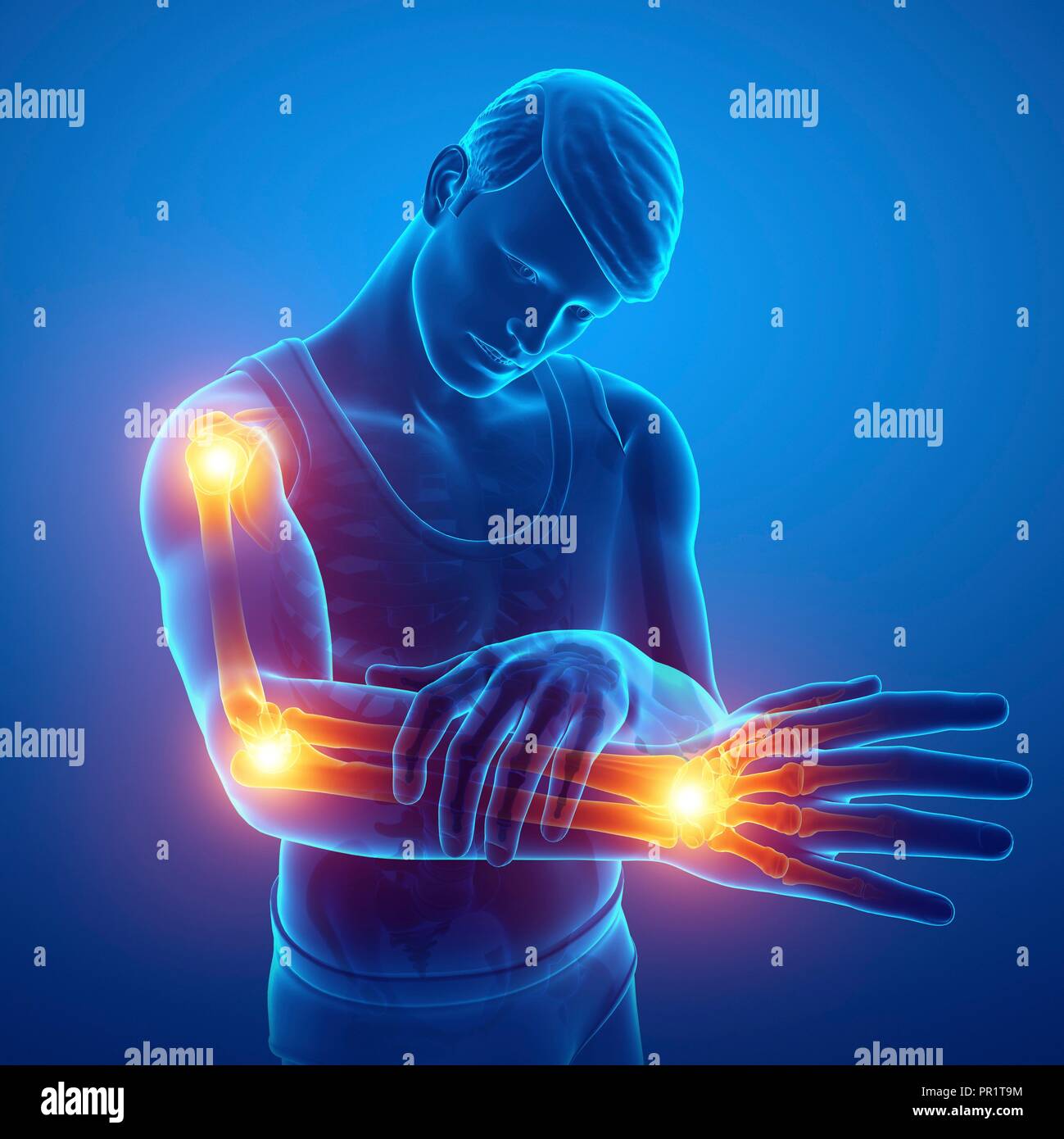 Man with arm pain, computer illustration Stock Photo Alamy