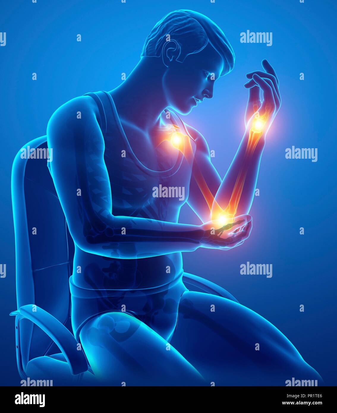 Man with arm pain, computer illustration Stock Photo Alamy