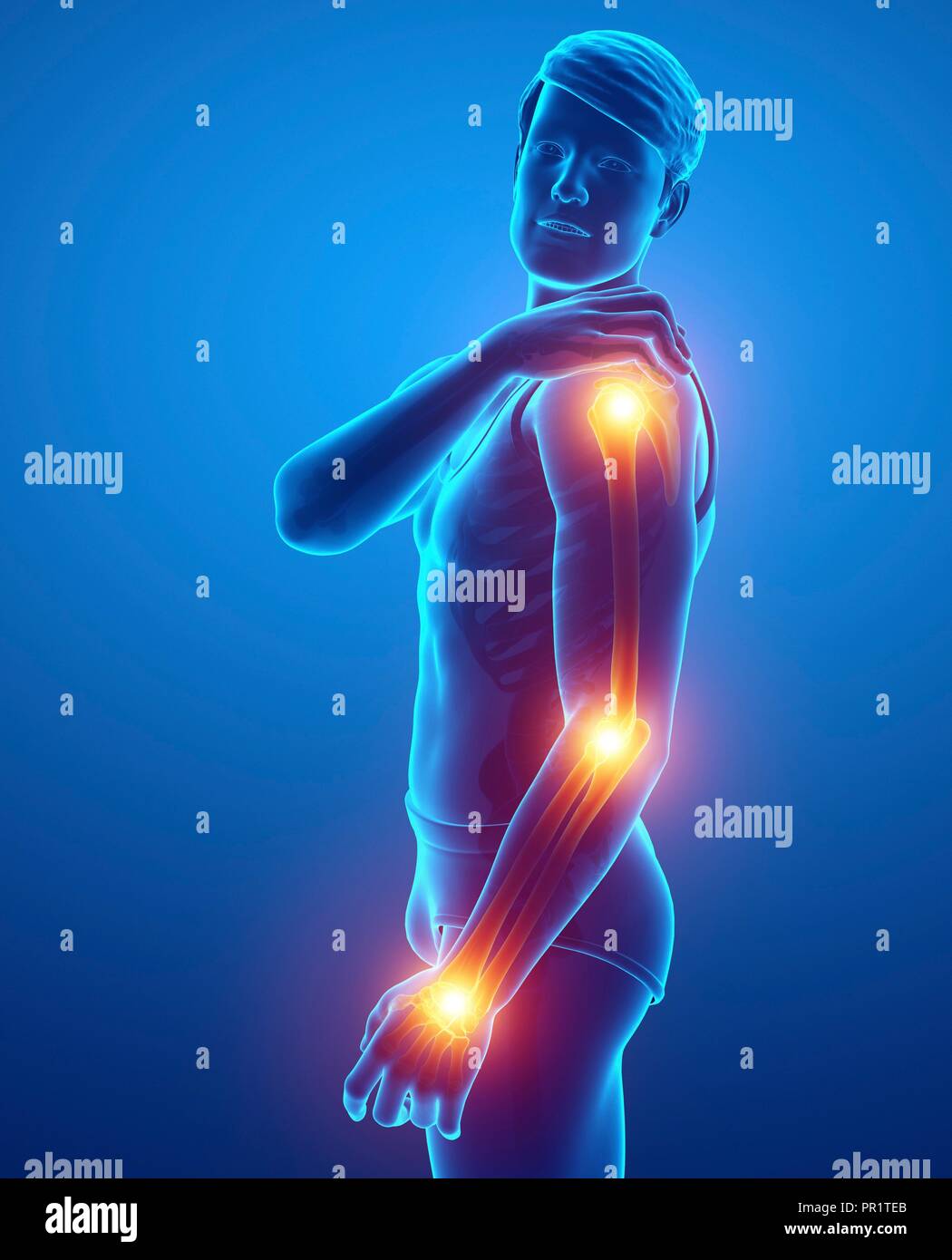 Man with arm pain, computer illustration Stock Photo Alamy