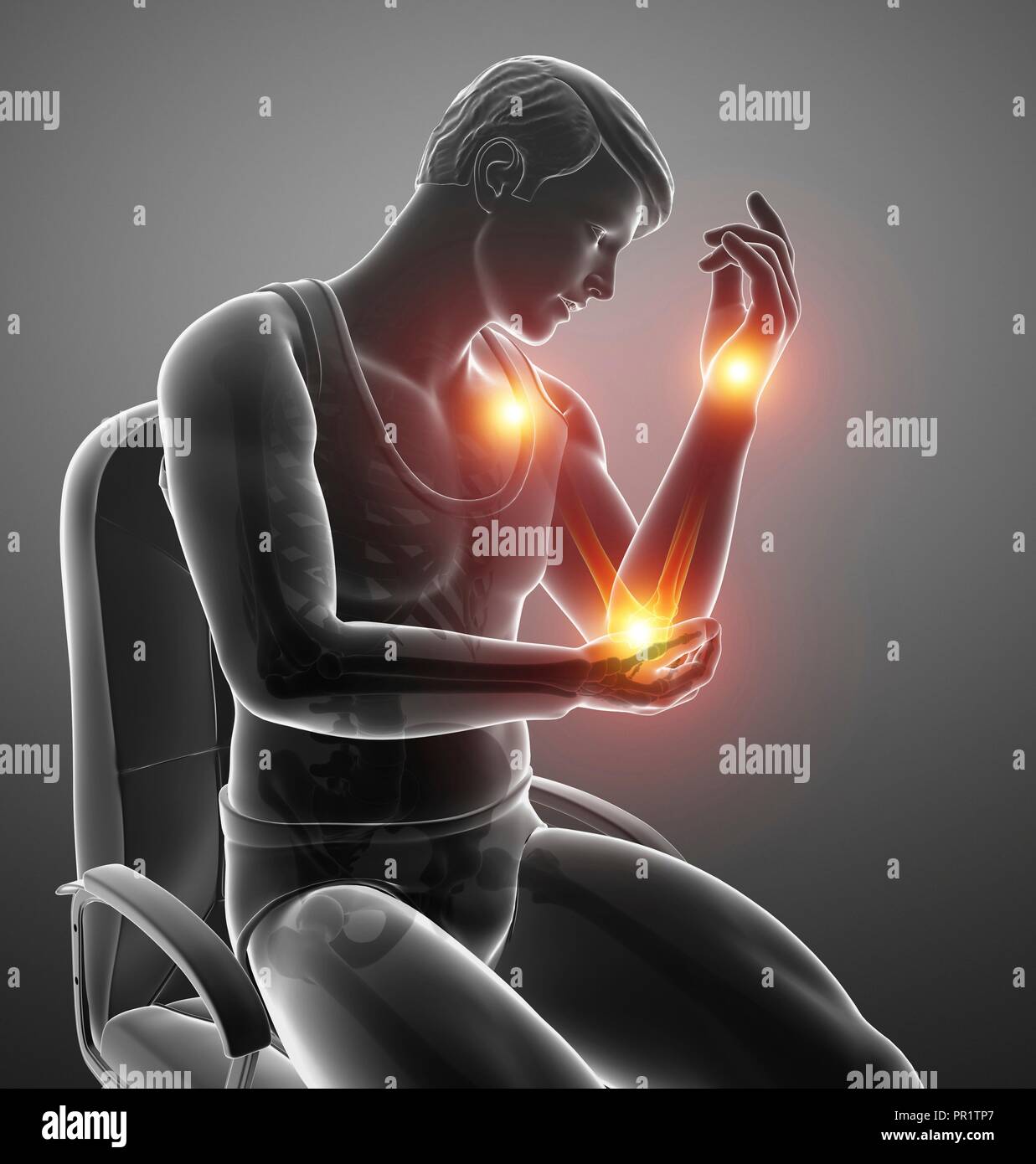 Man with arm pain, computer illustration Stock Photo Alamy