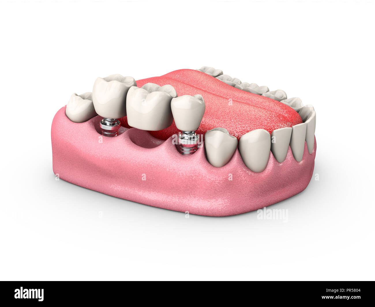 3d Illustration of a Fixed partial denture bridge, isolated white. Stock Photo