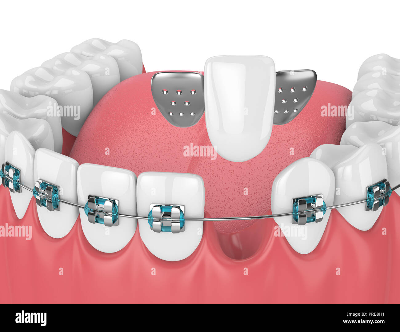 3d render of teeth with orthodontic braces and dental maryland bridge