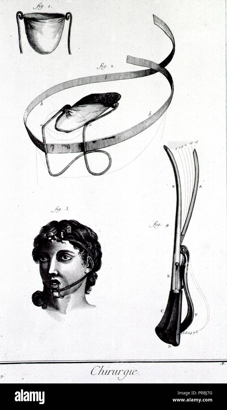Images include: a device that contains the tongue in a small linen sac is seen in its parts and in use, a bandage for a wounded tongue credited to M. Pibrac, and a lithotome caché. Stock Photo