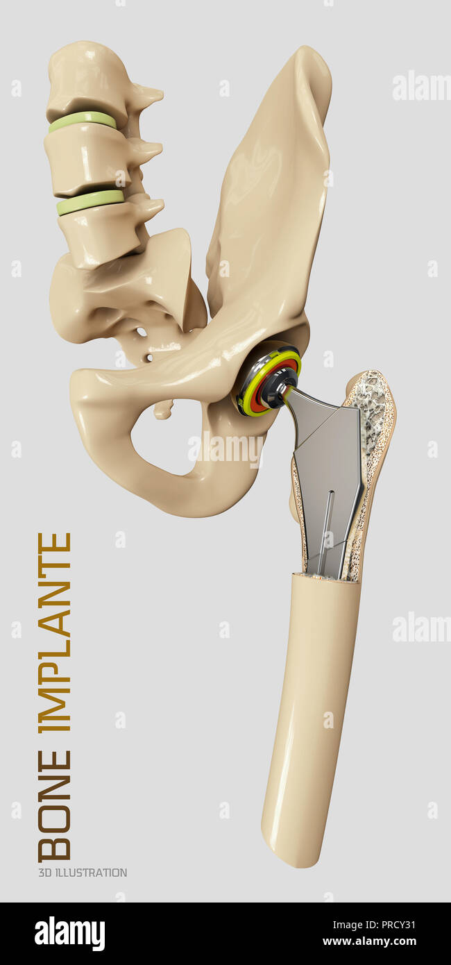 Hip joint replacement, artificial joint 3d Illustration Stock Photo