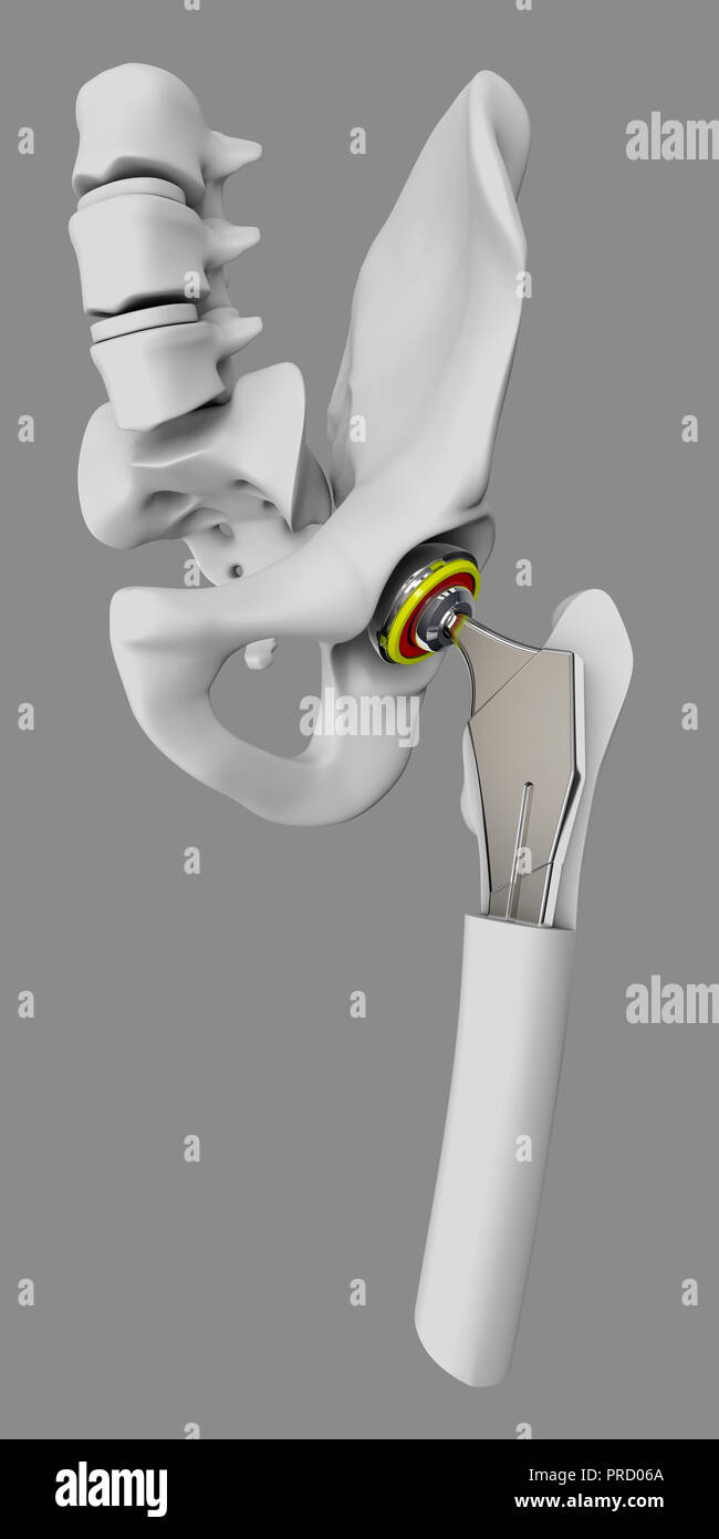 Hip joint replacement, artificial joint isolated gray 3d Illustration Stock Photo